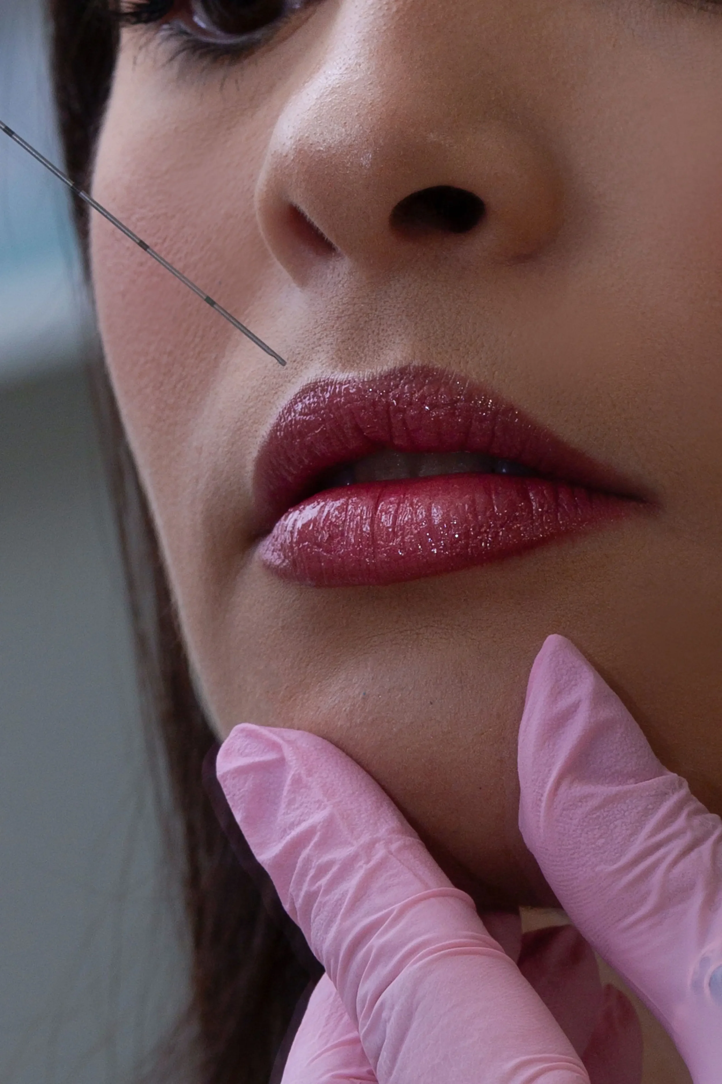 Lip Lift Surgery: The Procedure Everyone Is Talking About