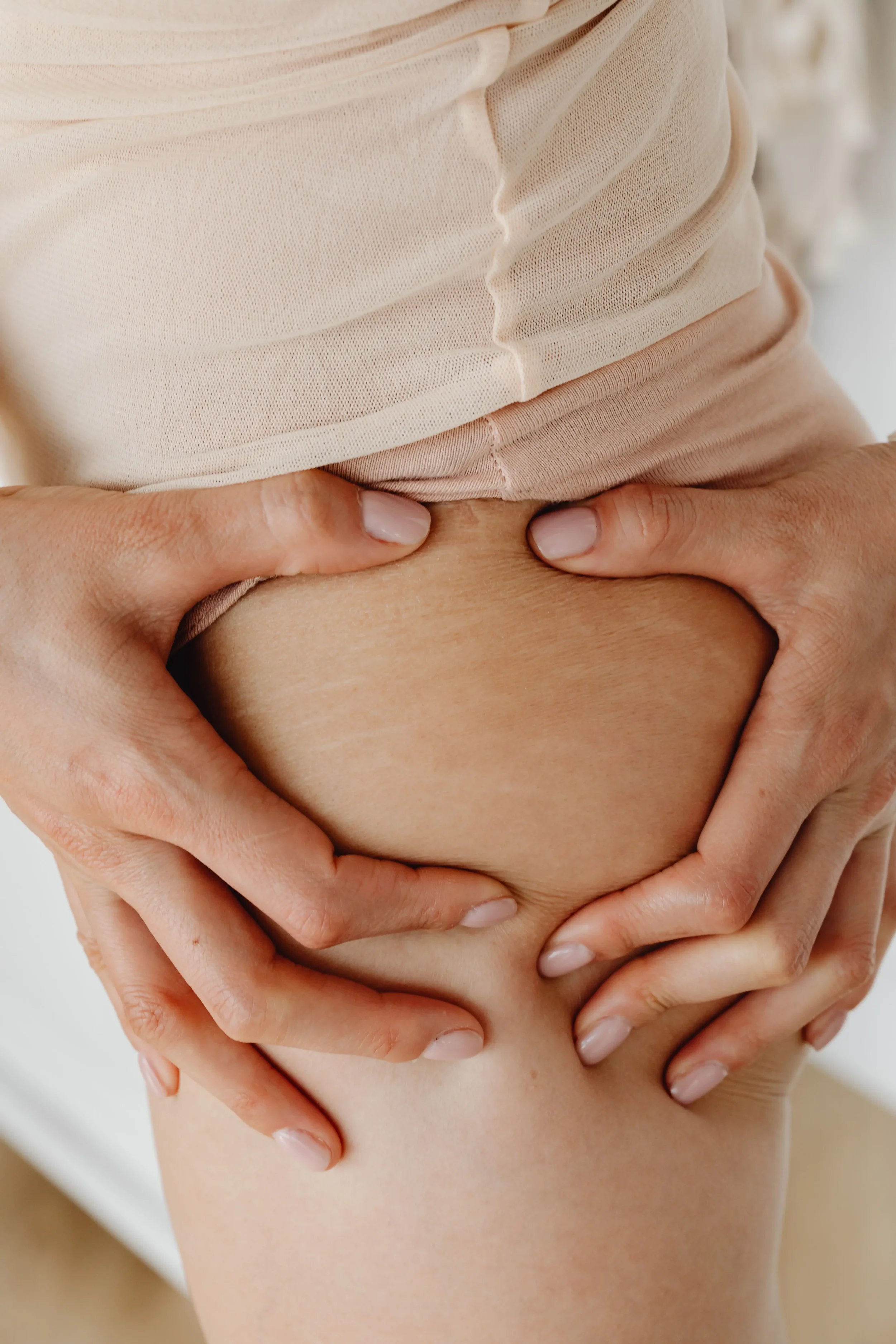 Cellulite Reduction With Subcision: A Targeted Treatment for Cellulite Dimples