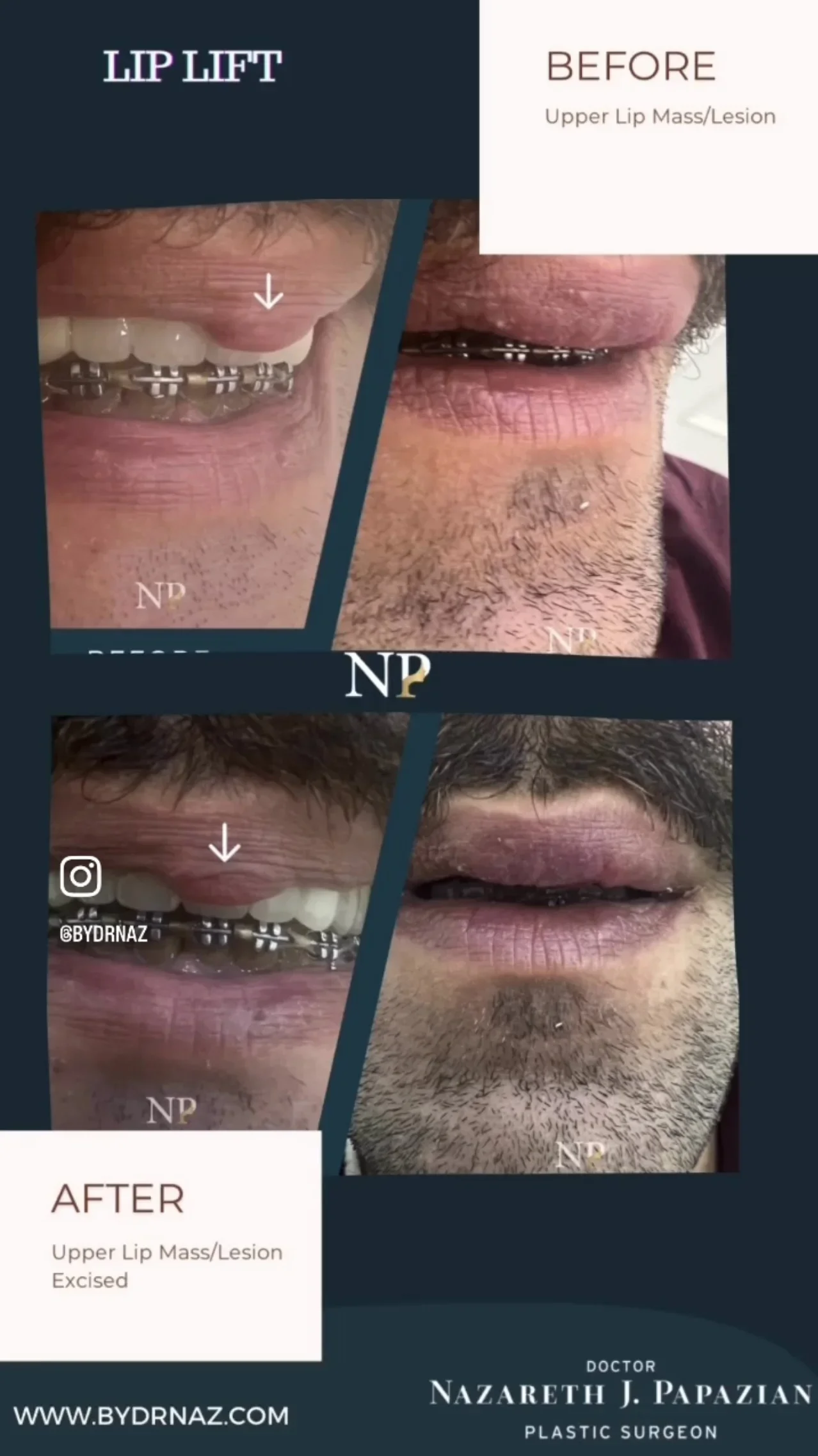 mass-excision-excision-dr-nazareth-papazian-plastic-surgery-lebanon.webp