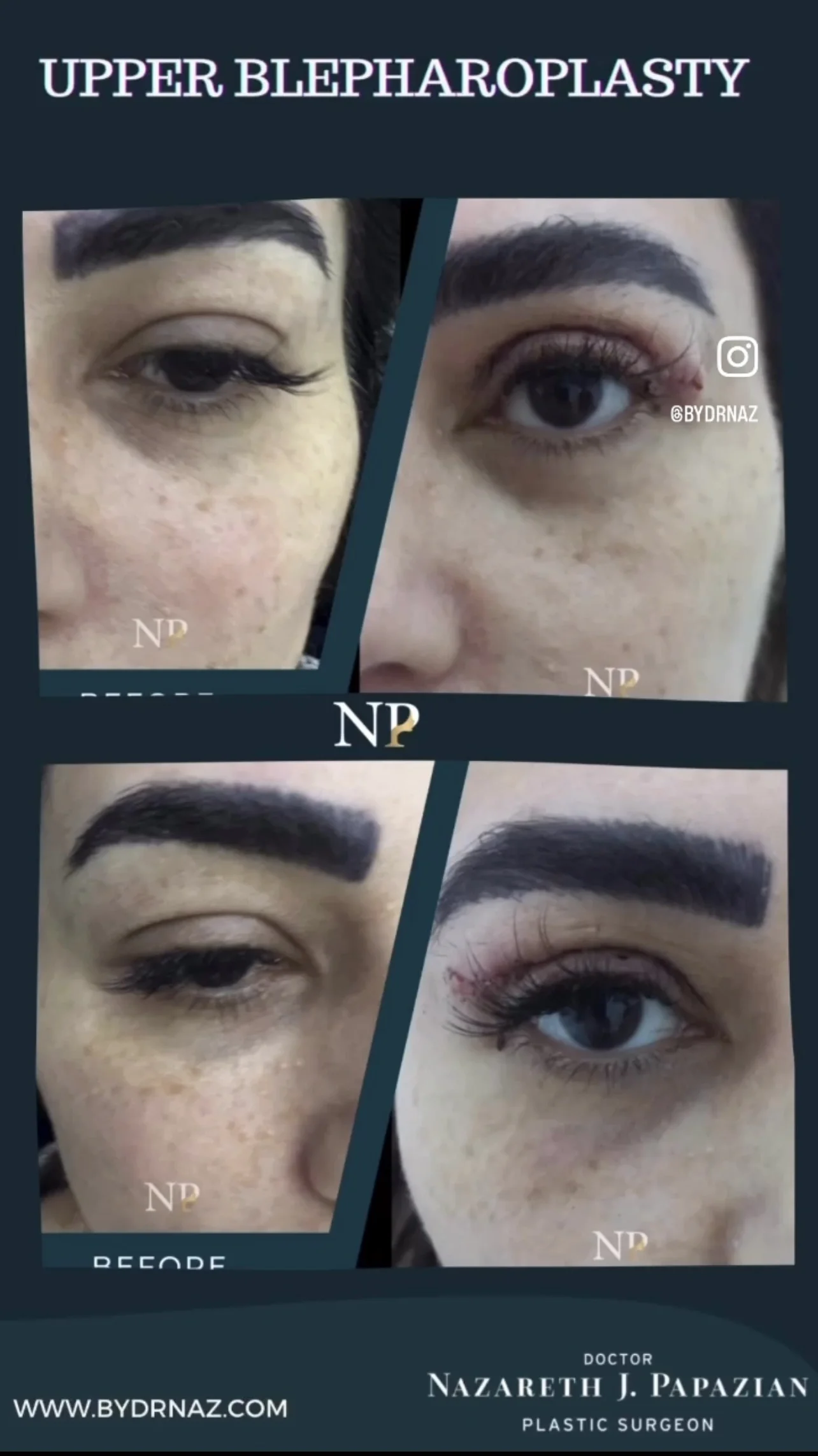 blepharoplasty-dr-nazareth-papazian-plastic-surgery-lebanon.webp