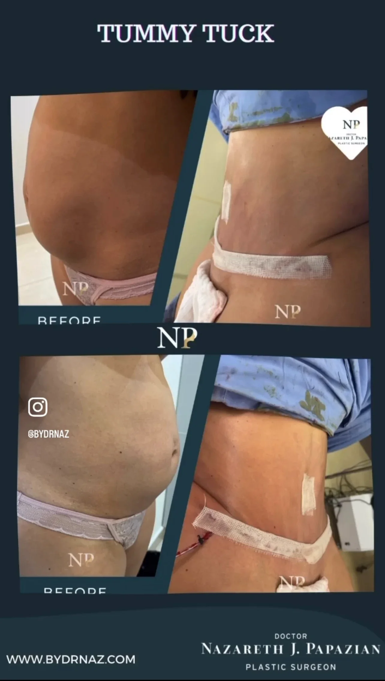 tummy-tuck-dr-nazareth-papazian-plastic-surgery-lebanon.webp