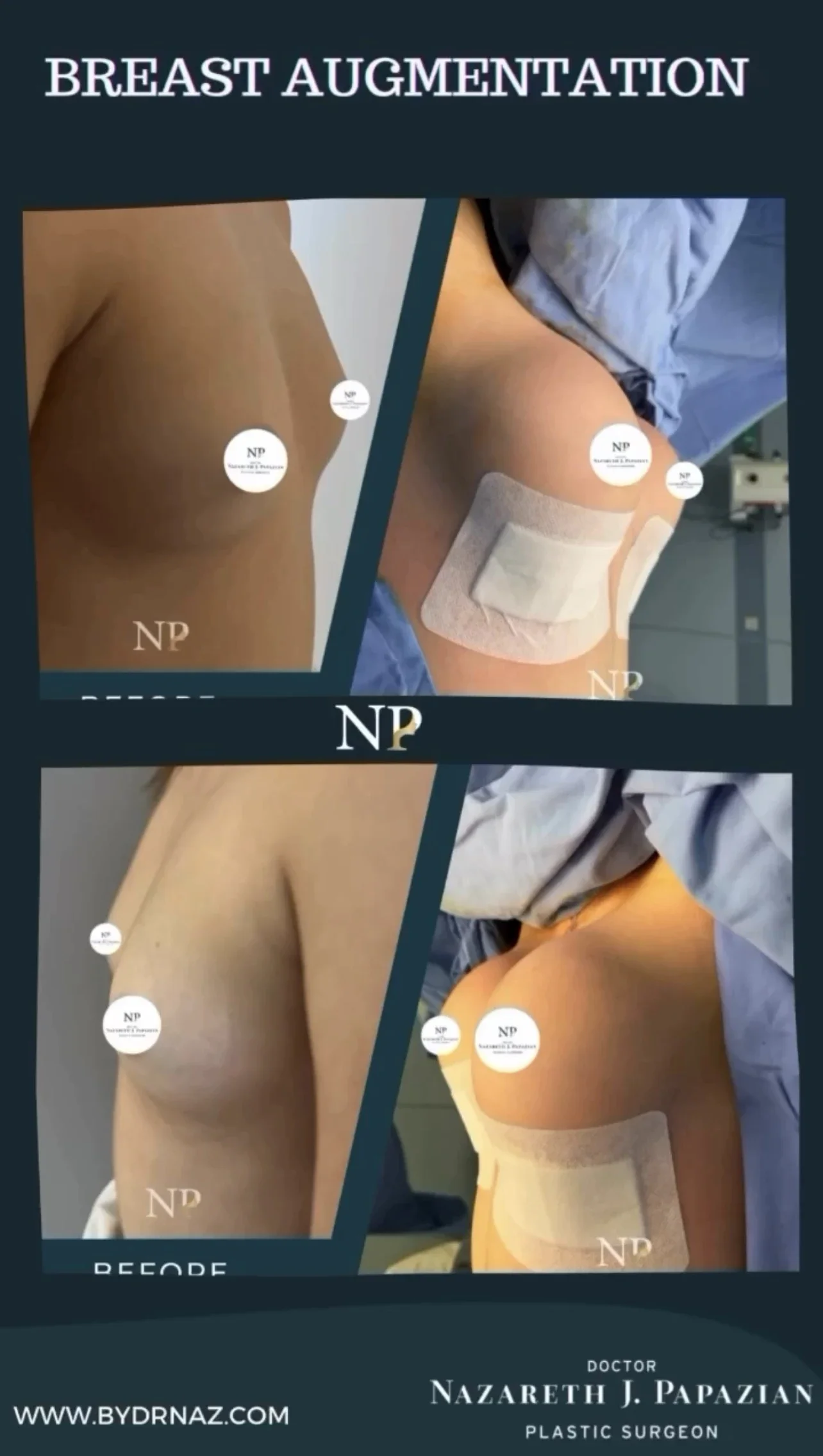 breast-augmentation-implants-dr-nazareth-papazian-plastic-surgery-lebanon.webp