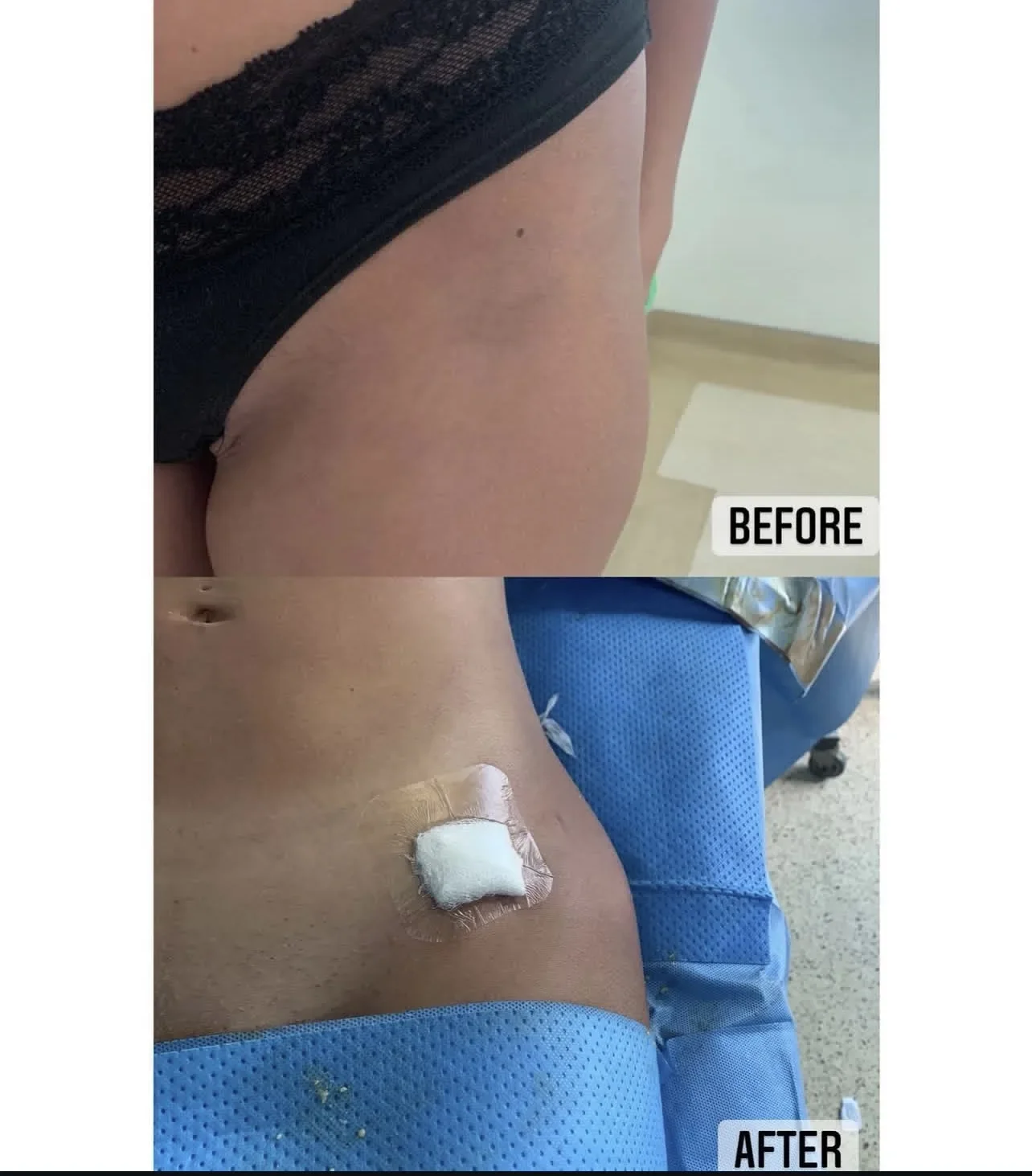 fat-transfer-dr-nazareth-papazian-plastic-surgery-lebanon.webp