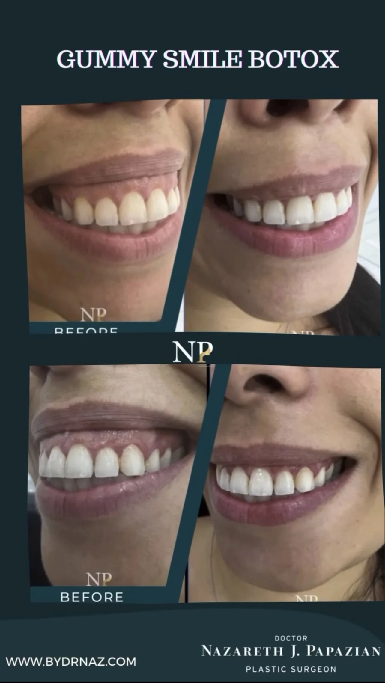 gummy-smile-botox-dr-nazareth-papazian-aesthetic-medicine-lebanon.webp