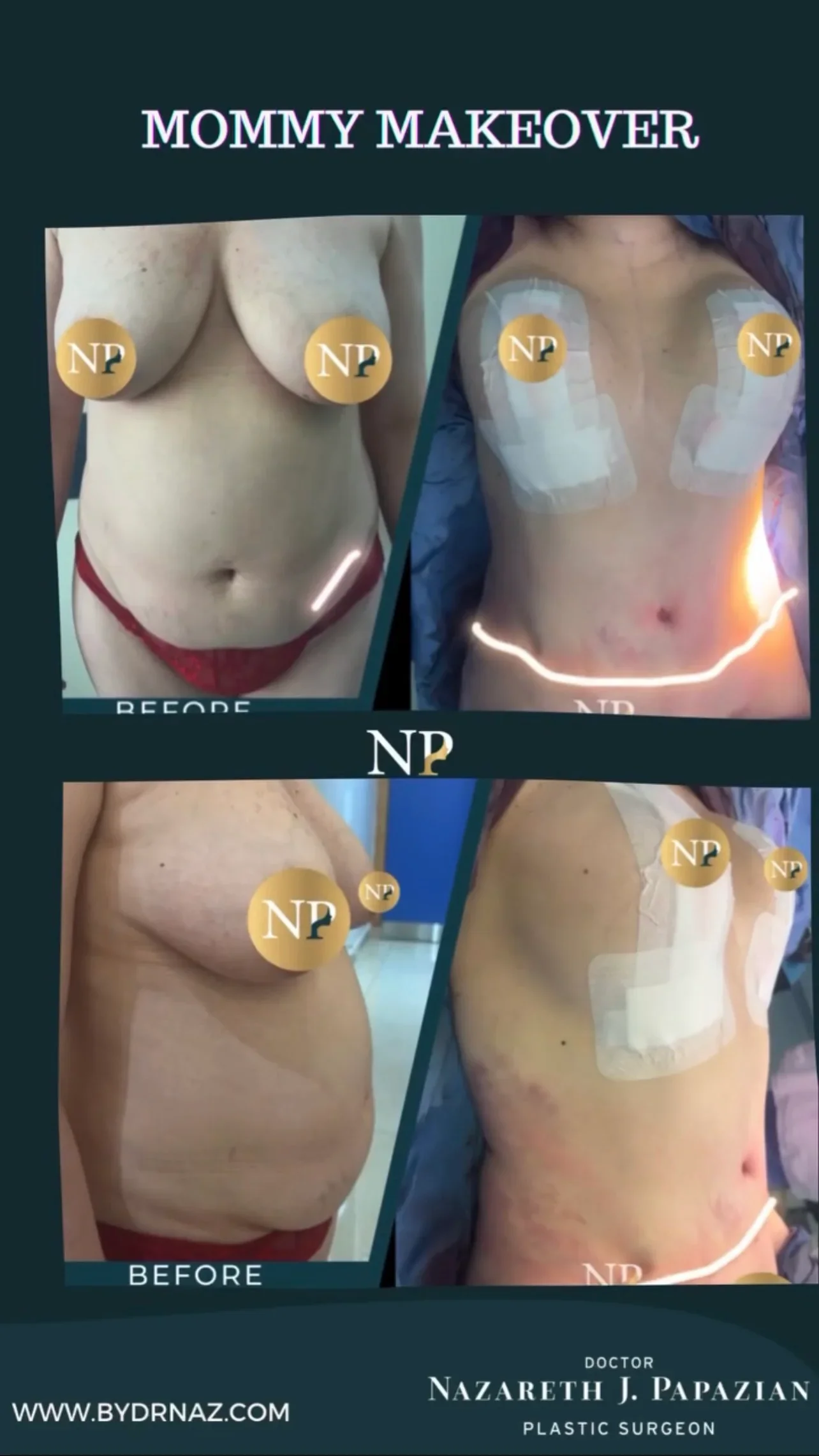 mommy-makeover-dr-nazareth-papazian-plastic-surgery-lebanon.webp