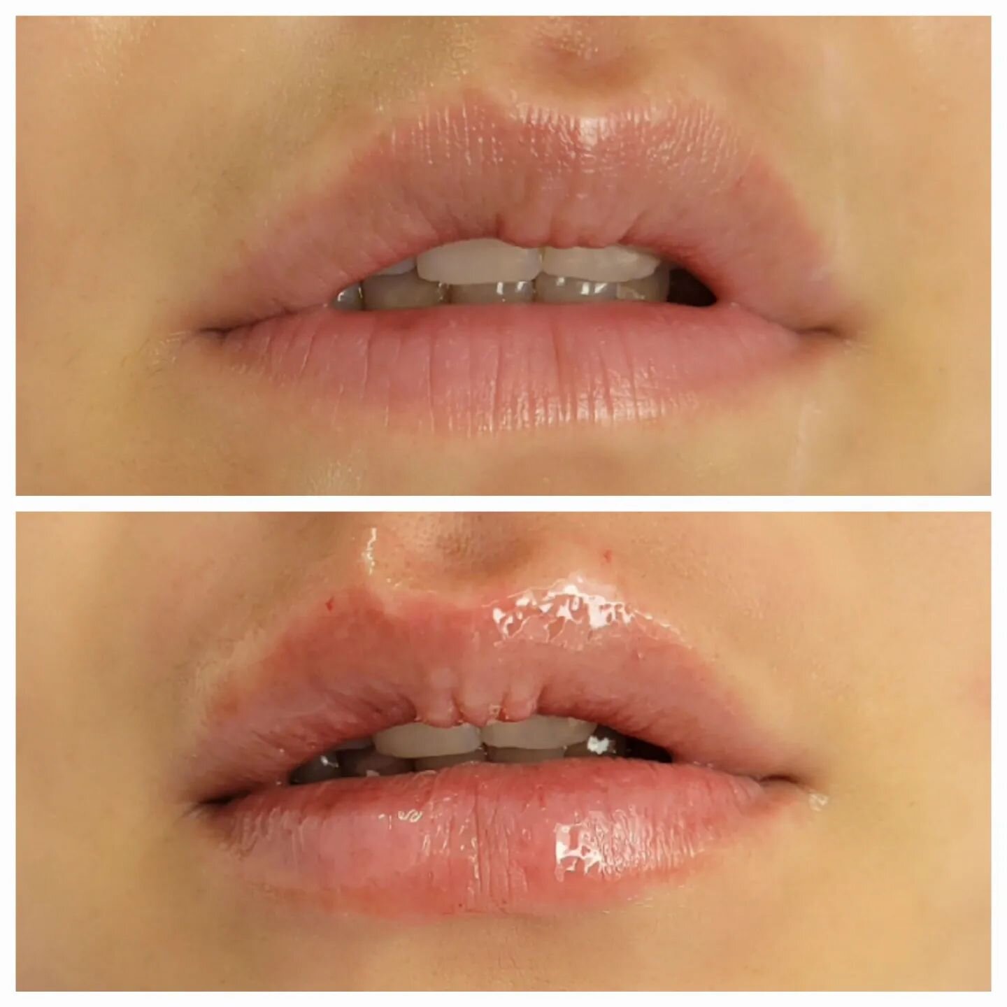 Hyaluronunterspritzung 
der Lippen nat&uuml;rlich?
Ja, aufgespritzte&nbsp;Lippen k&ouml;nnen nat&uuml;rlich&nbsp;wirken. Die neue Behandlung Belotero Lips, die auf zwei Fillern basiert, bringt im Ergebnis volle und wohlgeformte&nbsp;Lippen&nbsp;, ohn