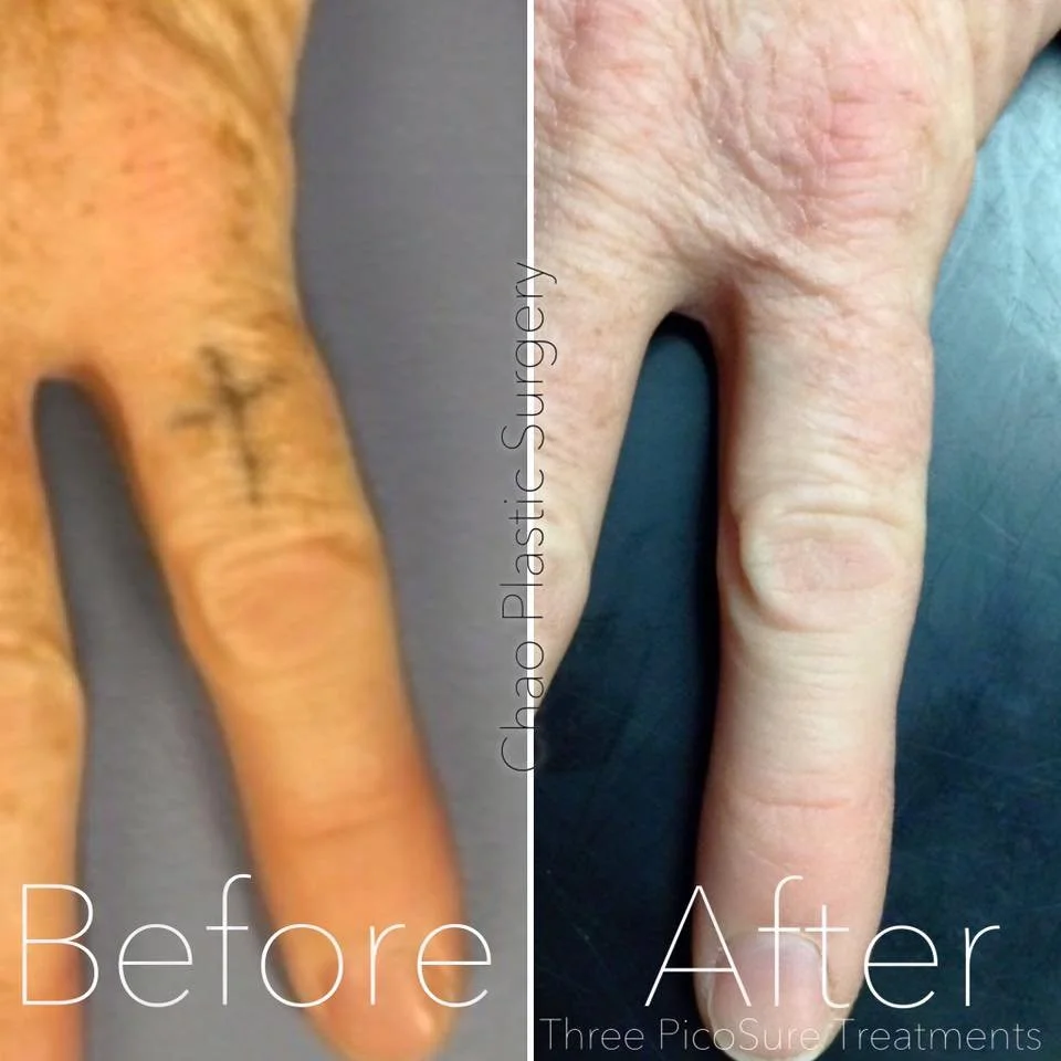 Chao_tattooremoval4.jpeg