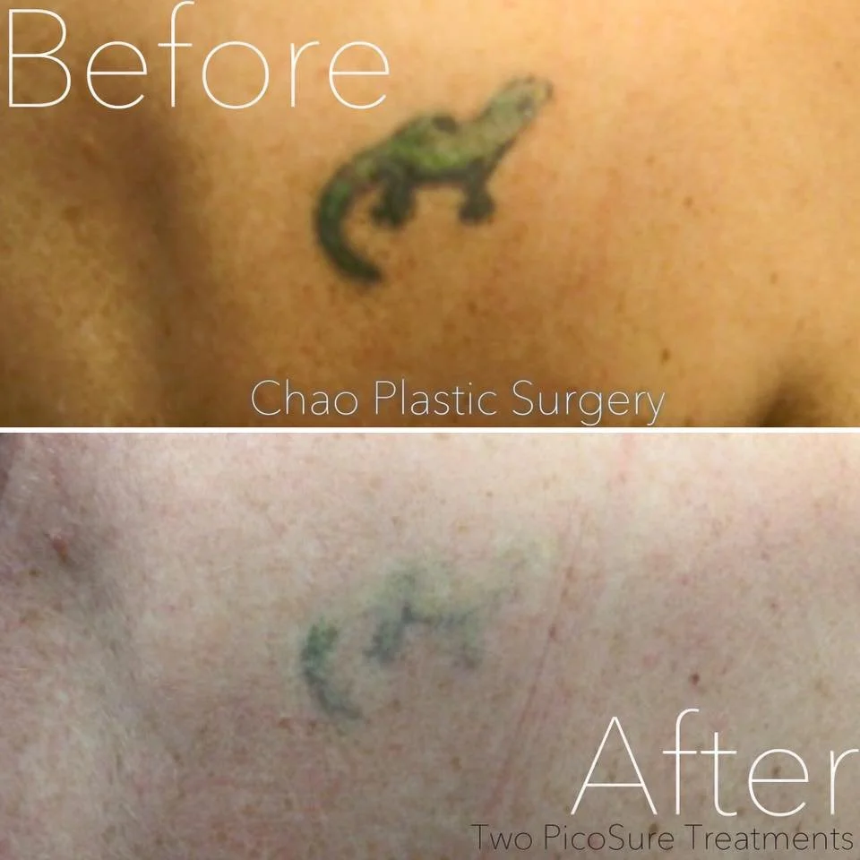 Chao_tattooremoval3.jpeg