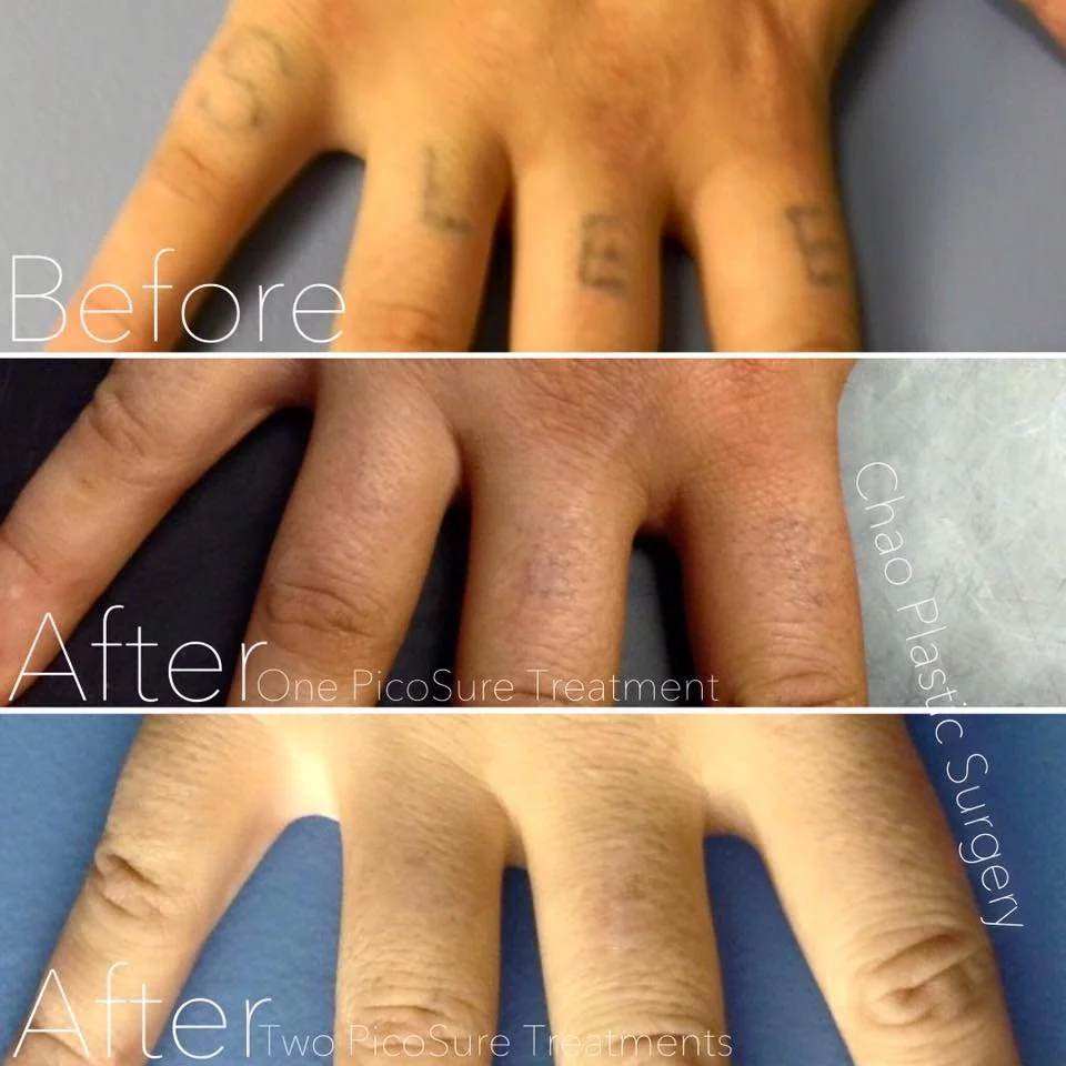 Chao_tattooremoval2.jpeg