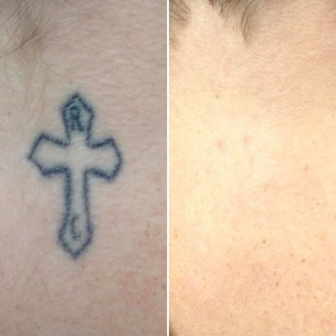 Chao_tattooremoval.jpeg
