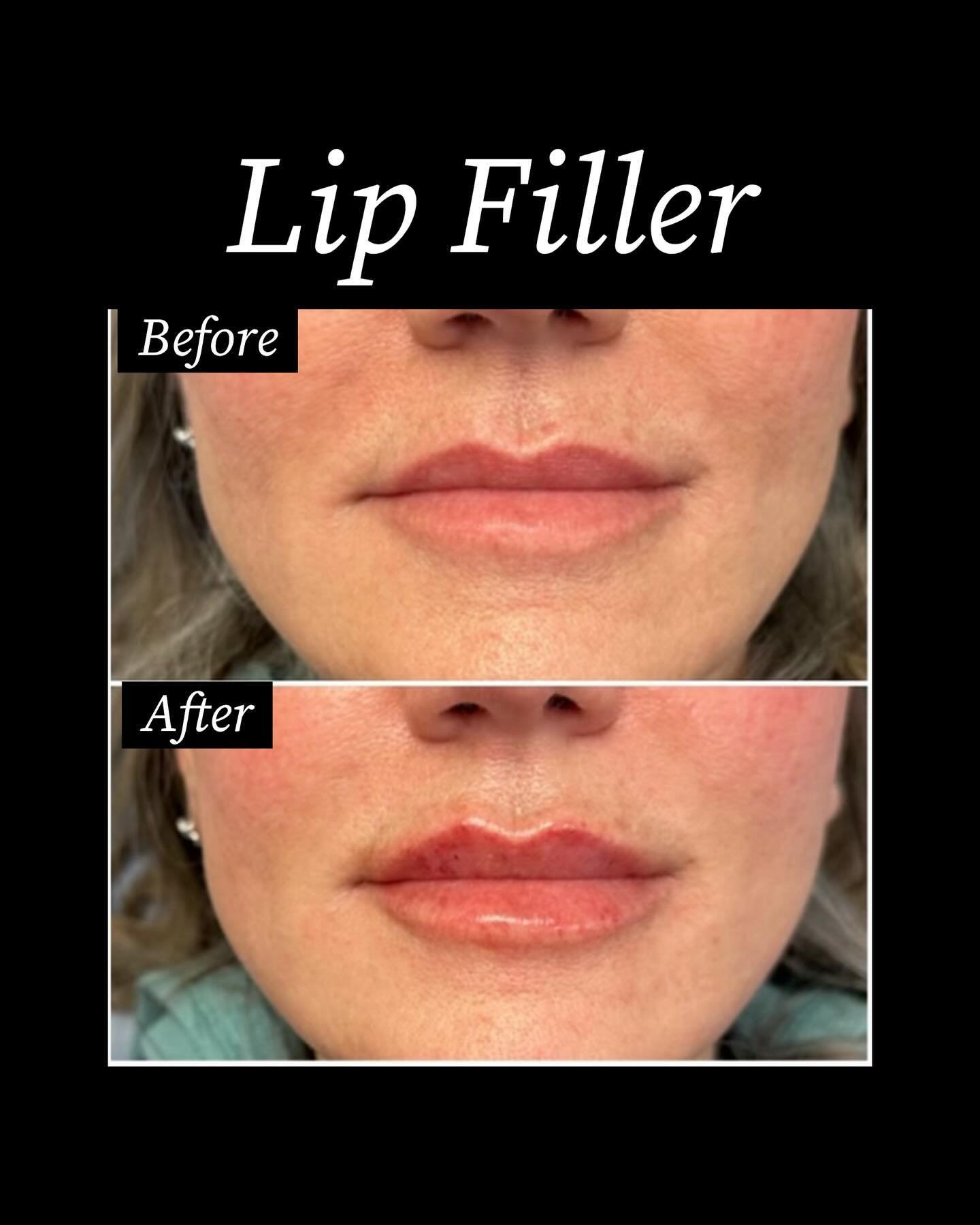 Another fresh set of 👄

😷 Treatment: Lip Filler 
🎯 Purpose: Lip fillers restore or add volume to your lips.
🎉 Results: Immediate 
✏️Note: Individual results may vary
📞 Phone: +1 5182032582
📬 Email: info@drchao.com
🌍 Website: www.drchao.com
📍 