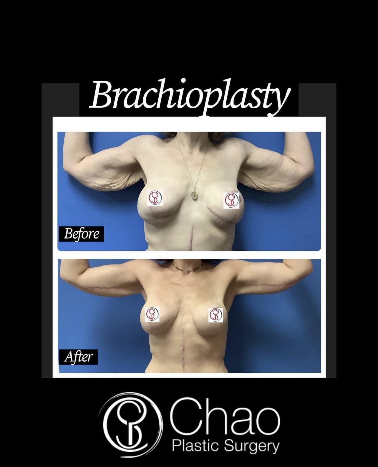 Brachioplasty 

😷 Treatment: Brachioplasty and Liposuction 
🎯 Purpose: To remove extra skin and fat to give a more toned and balanced appearance. Upper arm skin tends to droop with age, after significant weight loss, and for people with lymphedema
