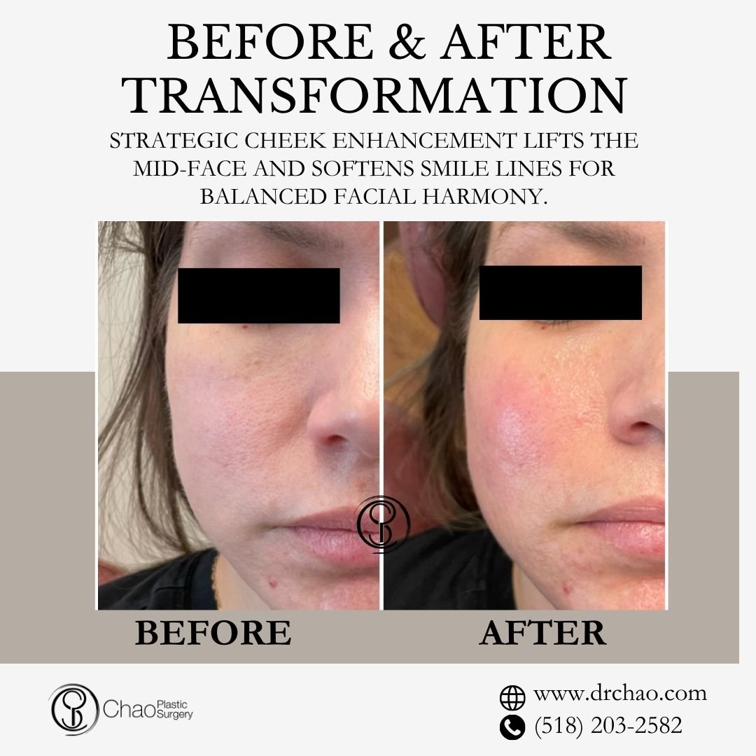 ✨ BEFORE &amp; AFTER TRANSFORMATION ✨

Restoring youthful volume to the cheeks creates a subtle yet significant rejuvenation effect! This strategic cheek enhancement lifts and defines the mid-face, softening nasolabial folds and creating overall faci