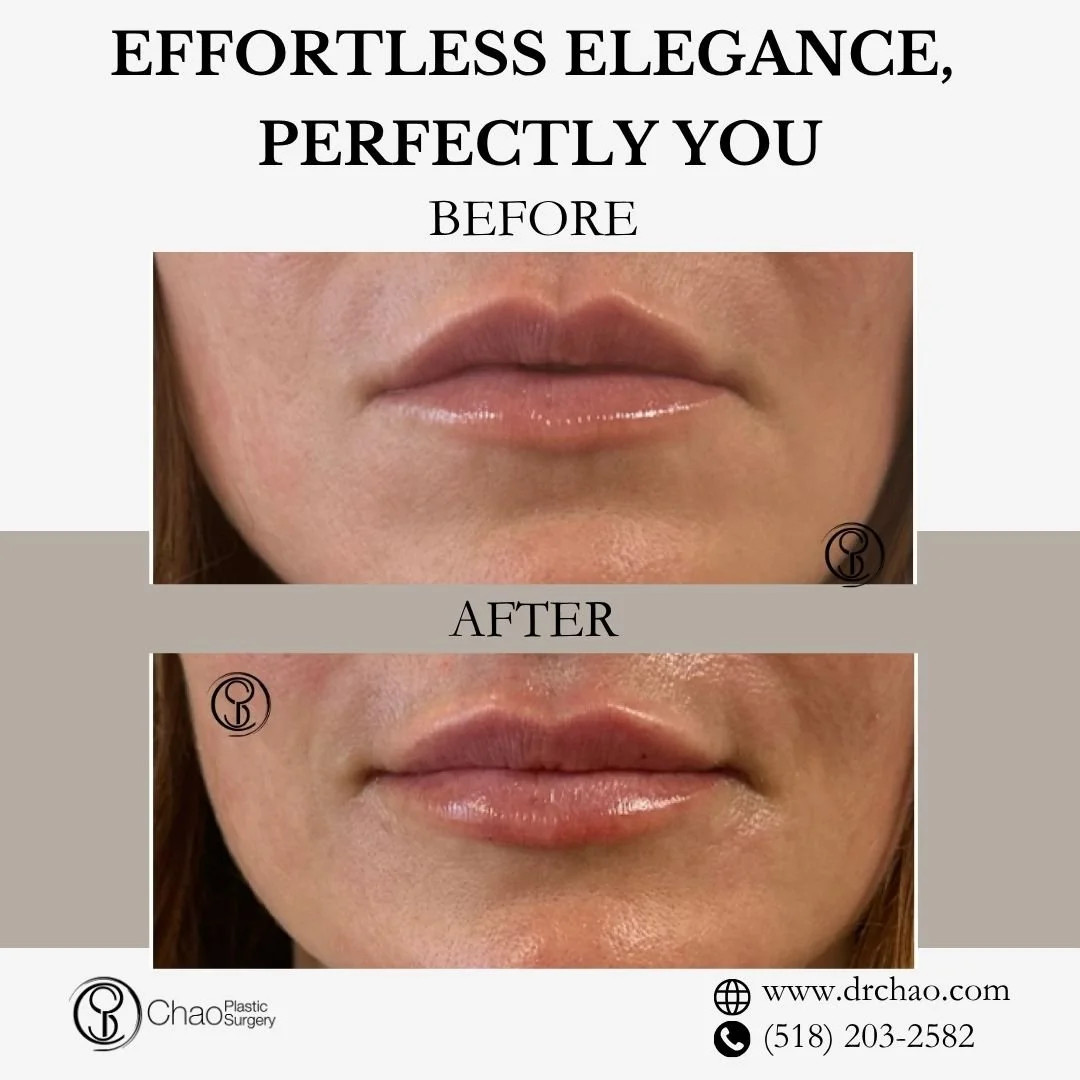 ✨ BEFORE &amp; AFTER TRANSFORMATION ✨

Gorgeous lip transformation that enhances natural beauty! This treatment created the perfect balance of volume and definition while preserving the patient's natural lip character and movement.

😷 Treatment: Lip