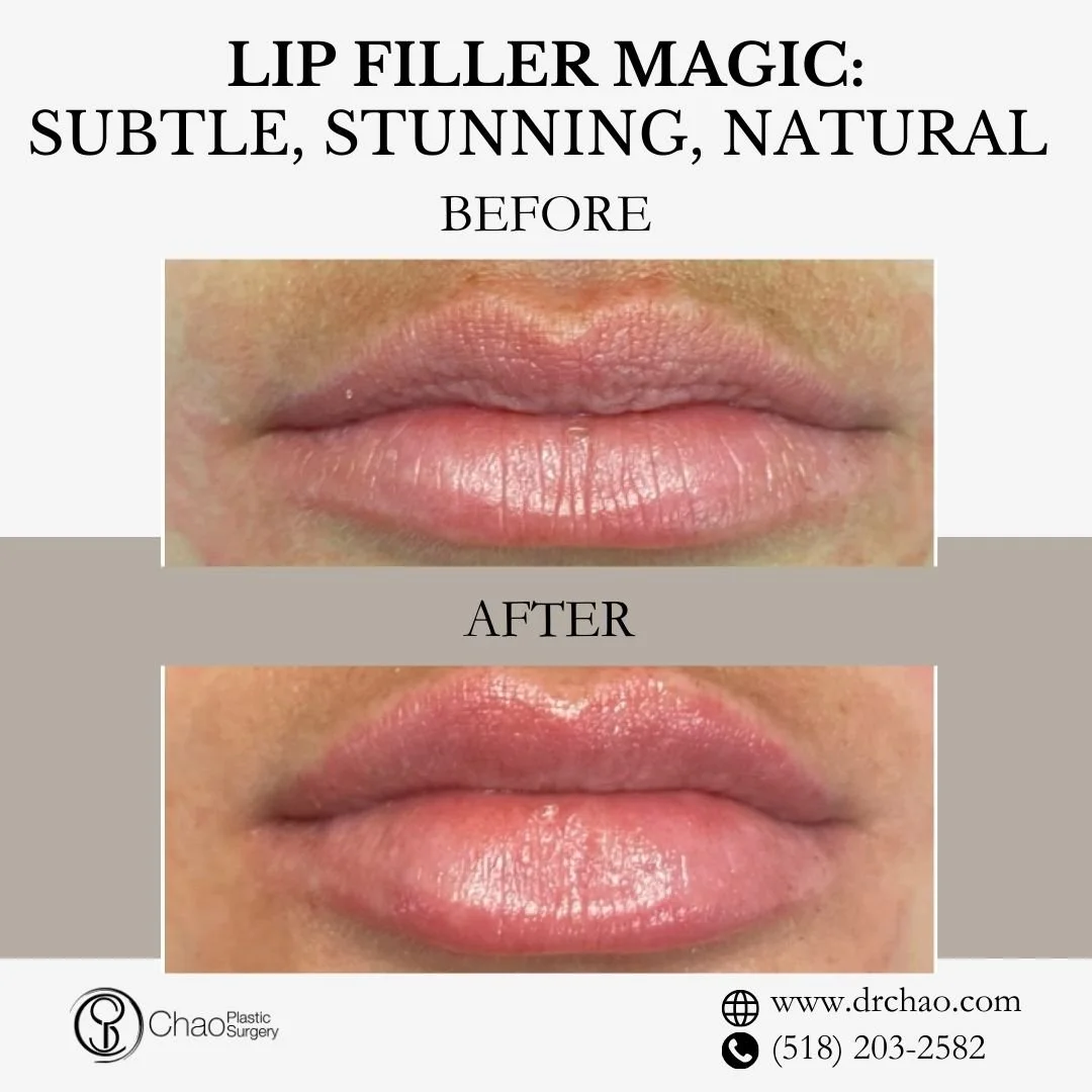 ✨ BEFORE &amp; AFTER TRANSFORMATION ✨

Gorgeous lip enhancement with exceptional artistry! This patient's lips were skillfully enhanced to create beautiful volume and definition that looks completely natural and enhances their smile.

😷 Treatment: L