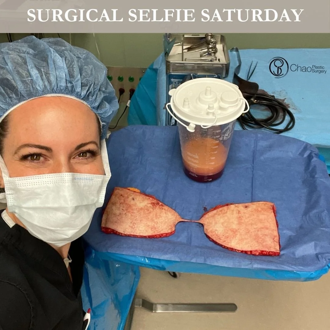 💉 Good morning! It's SURGICAL SELFIE SATURDAY 💉

Here we have our PA Beckie with one of her surgical selfies after she and Dr Chao completed another life changing surgical transformation in the OR.

😷 Treatment: Tummy Tuck (Abdominoplasty) with Li