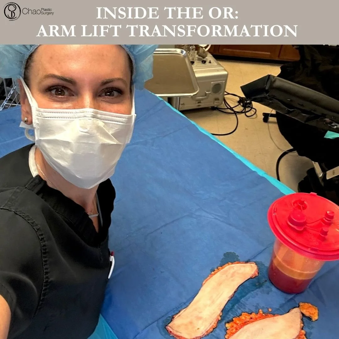 💉 Good morning! It's SURGICAL SELFIE SATURDAY 💉

Here we have our PA Beckie with one of her surgical selfies after she and Dr Chao completed another life changing surgical transformation in the OR.

😷 Treatment: Brachioplasty (Arm Lift) 
🎯 Purpos