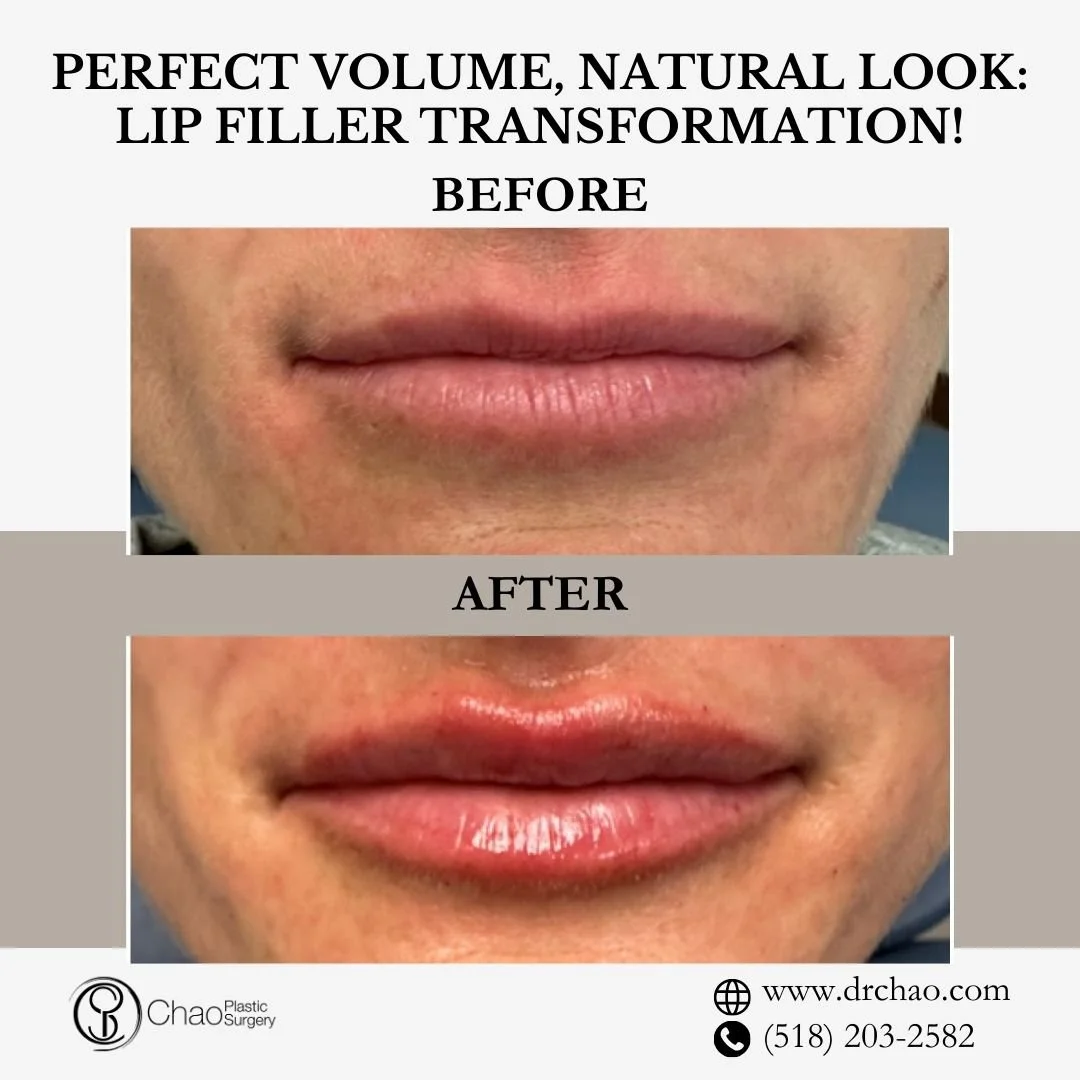✨ BEFORE &amp; AFTER TRANSFORMATION ✨

Expertly enhanced lips that look completely natural! This treatment created perfect volume and definition while maintaining the patient's unique lip character and ideal facial proportions.

😷 Treatment: Lip Fil