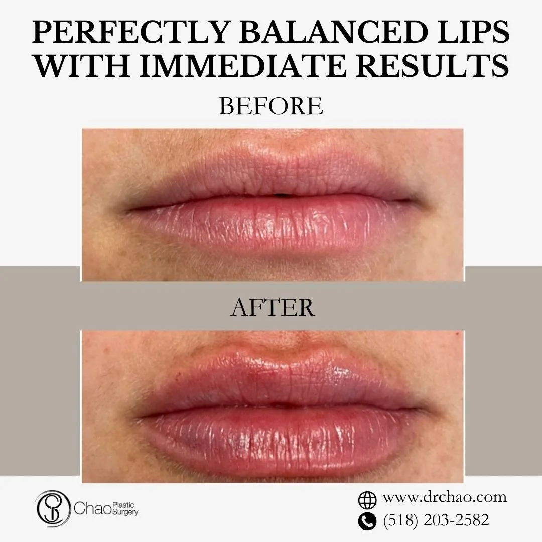 ✨ BEFORE &amp; AFTER TRANSFORMATION ✨

Stunning lip transformation with artistic precision! This patient achieved fuller, more defined lips that enhance their natural beauty and create perfect facial harmony.

😷 Treatment: Lip Filler 
🎯 Purpose: Li