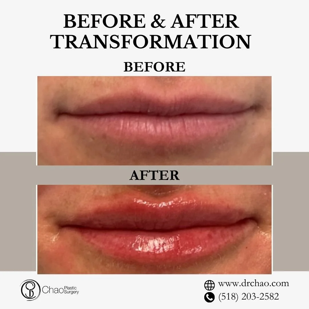 ✨ BEFORE &amp; AFTER TRANSFORMATION ✨

Flawless lip enhancement that celebrates natural beauty! This treatment added ideal volume while preserving the patient's authentic lip shape and creating beautiful facial balance.

😷 Treatment: Lip Filler 
🎯 