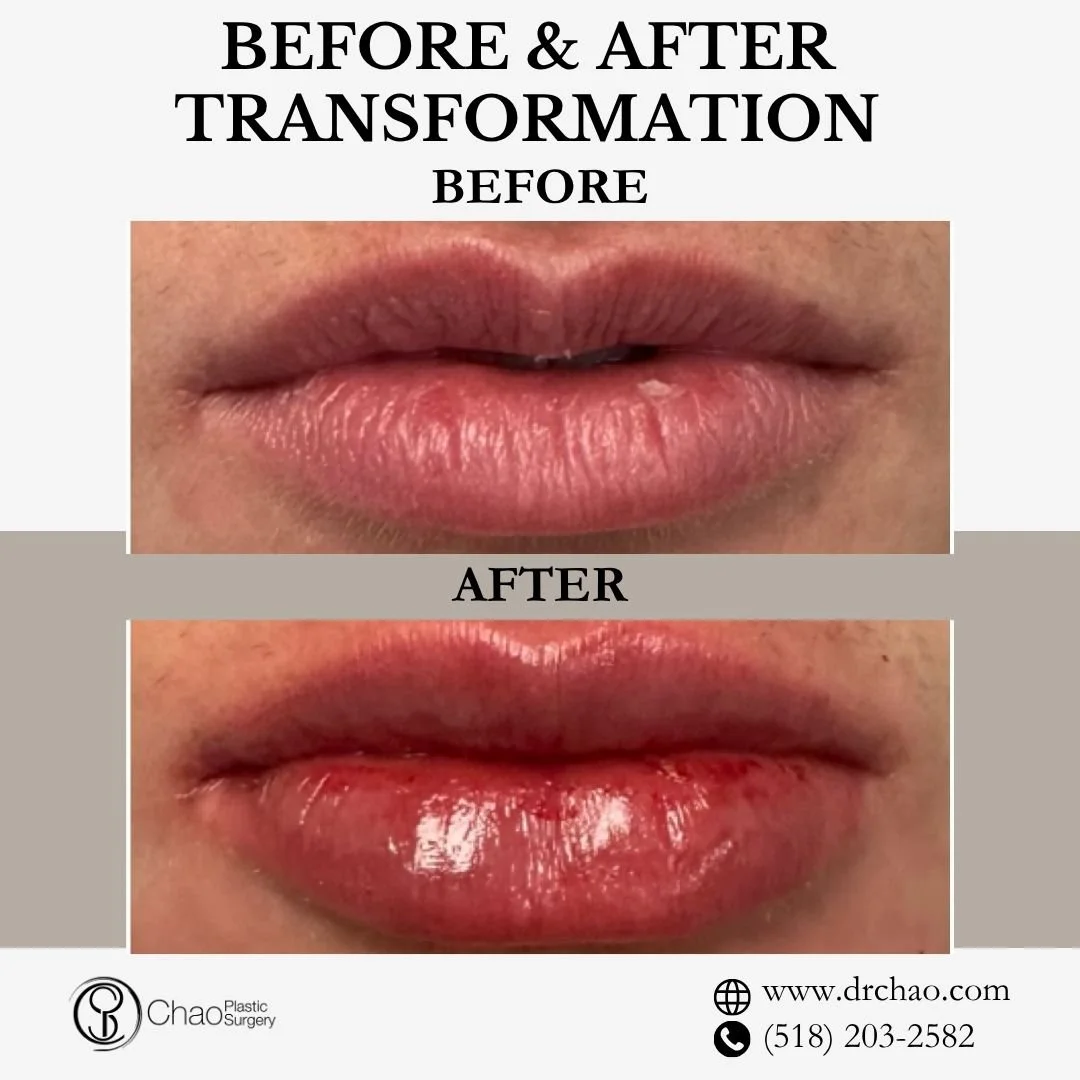 ✨ BEFORE &amp; AFTER TRANSFORMATION ✨

Beautiful lip enhancement that looks completely natural! This treatment created ideal volume and definition while maintaining the patient's unique lip shape and perfect facial harmony.

😷 Treatment: Lip Filler 