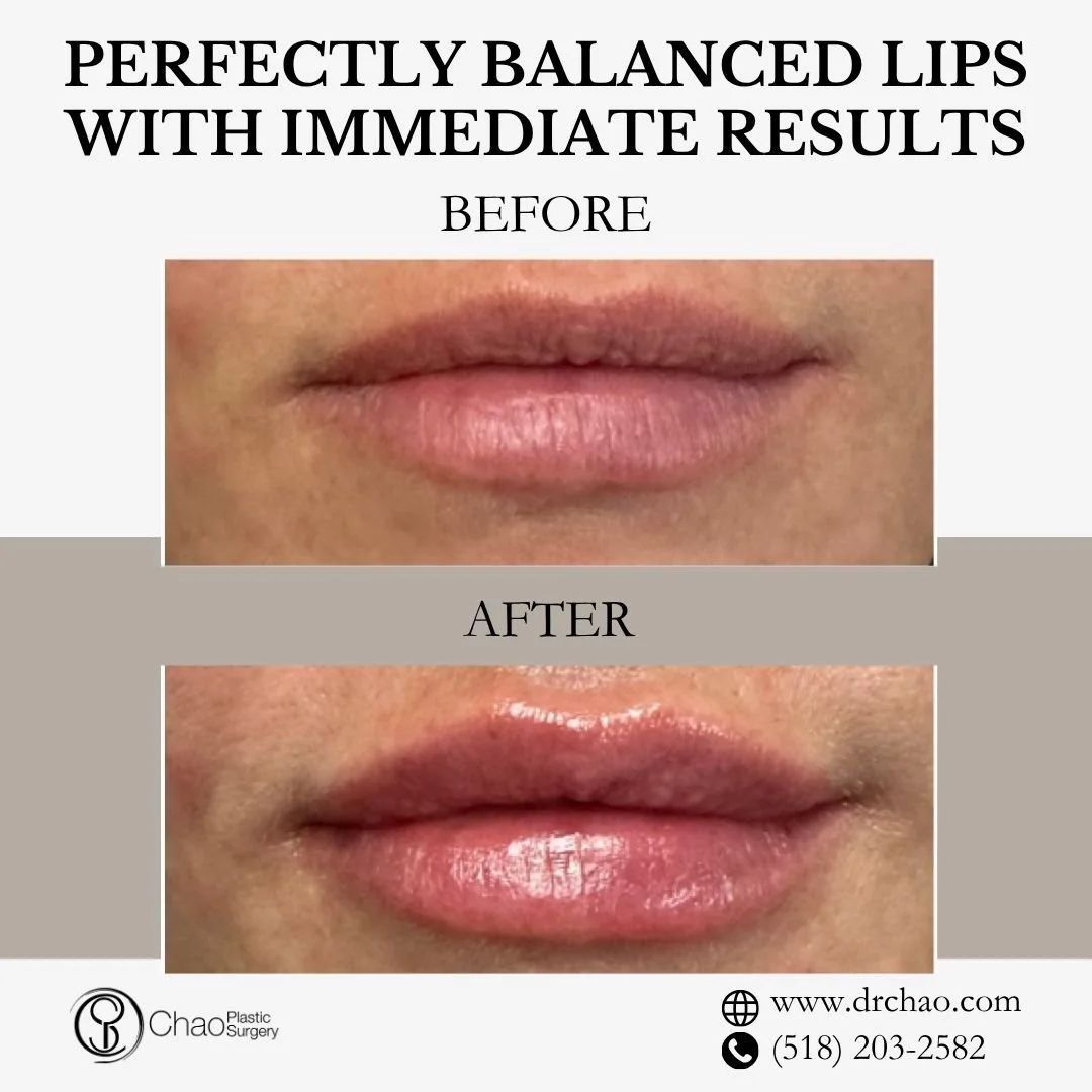✨ BEFORE &amp; AFTER TRANSFORMATION ✨

Perfectly enhanced lips that celebrate natural beauty! This treatment added beautiful volume while preserving the patient's authentic lip character and creating ideal proportions.

😷 Treatment: Lip Filler 
🎯 P