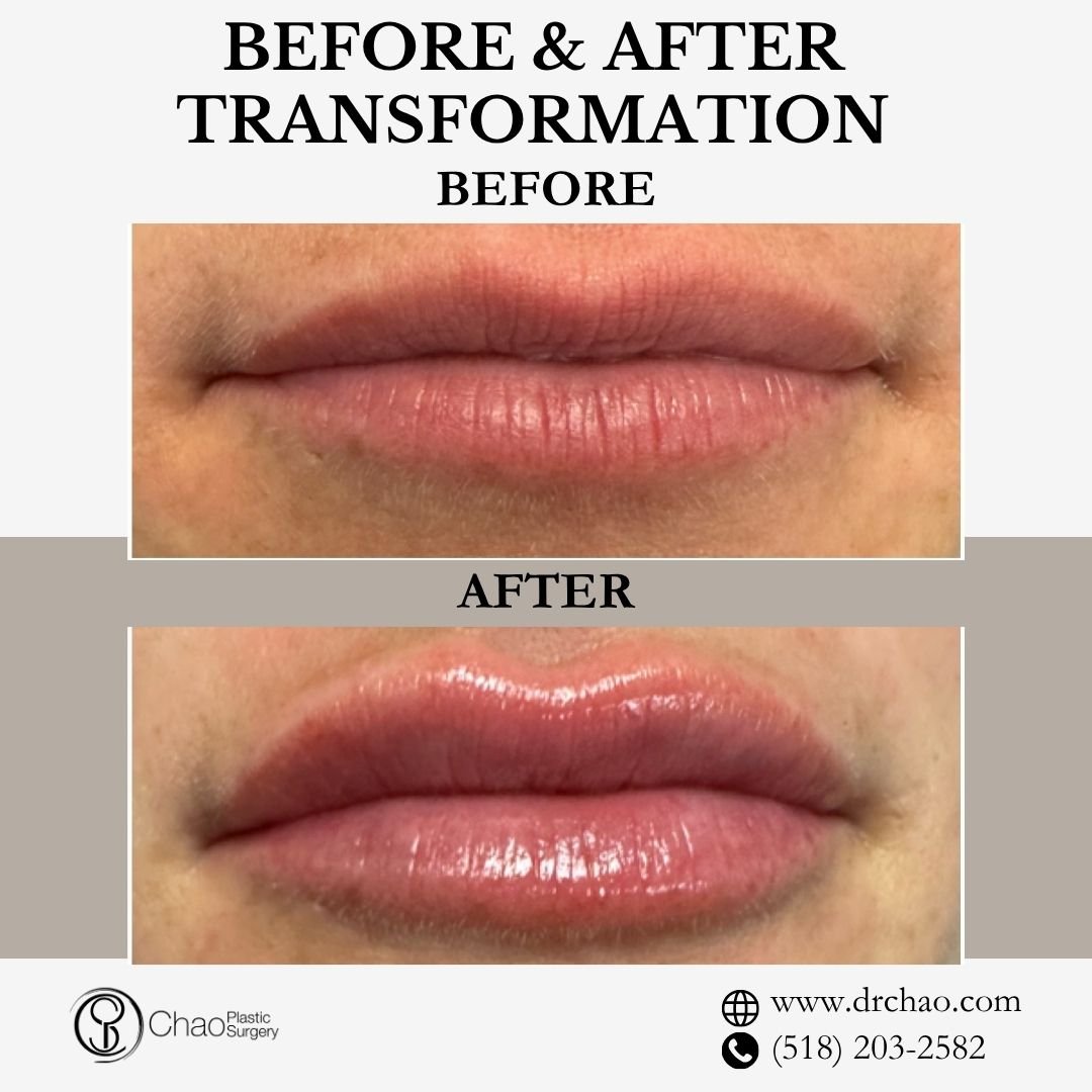 ✨ BEFORE &amp; AFTER TRANSFORMATION ✨

Beautiful lip enhancement with expert artistry! This treatment created stunning volume and definition while maintaining the patient's natural lip character for perfectly balanced results.

😷 Treatment: Lip Fill