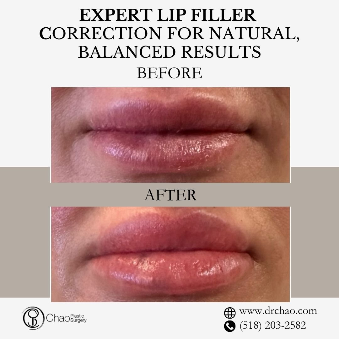 ✨ BEFORE &amp; AFTER TRANSFORMATION ✨

Expert lip filler correction for natural, balanced results! This patient came to us with overfilled lips, and we carefully corrected the shape and proportion for a more harmonious, beautiful appearance.

😷 Trea
