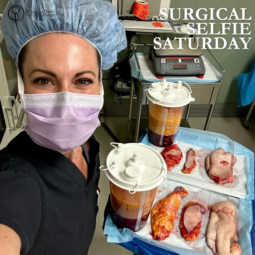 💉 Good morning! It's SURGICAL SELFIE SATURDAY 💉

Here we have our PA Beckie with one of her surgical selfies after she and Dr Chao completed another life changing surgical transformation in the OR.

😷 Treatment: Inner Thigh Lift, Abdomen/Flank Lip