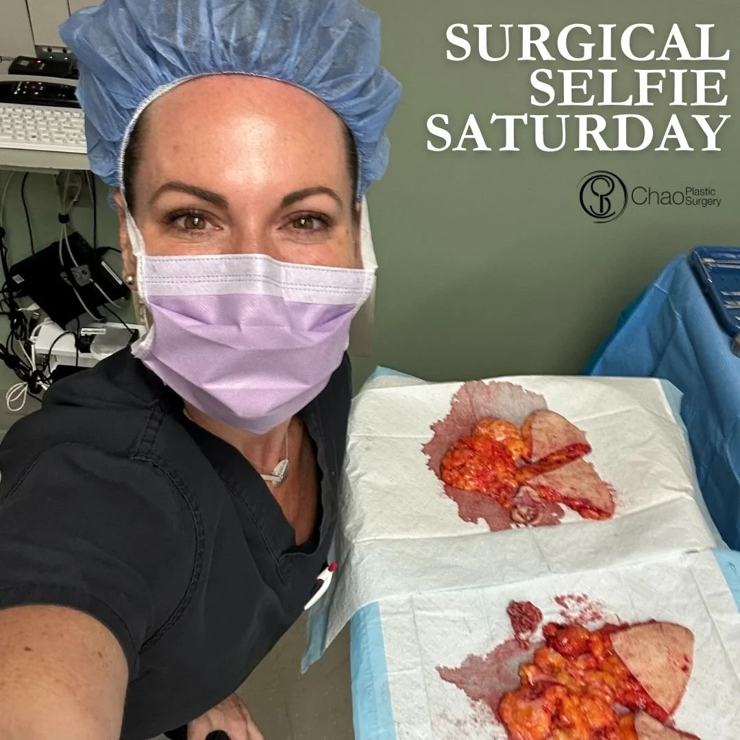 💉 Good day! It's SURGICAL SELFIE SATURDAY 💉

Here we have our PA Beckie with one of her surgical selfies after she and Dr Chao completed another life changing surgical transformation in the OR.

😷 Treatment: Mastopexy/Reduction (Breast Lift/Reduct