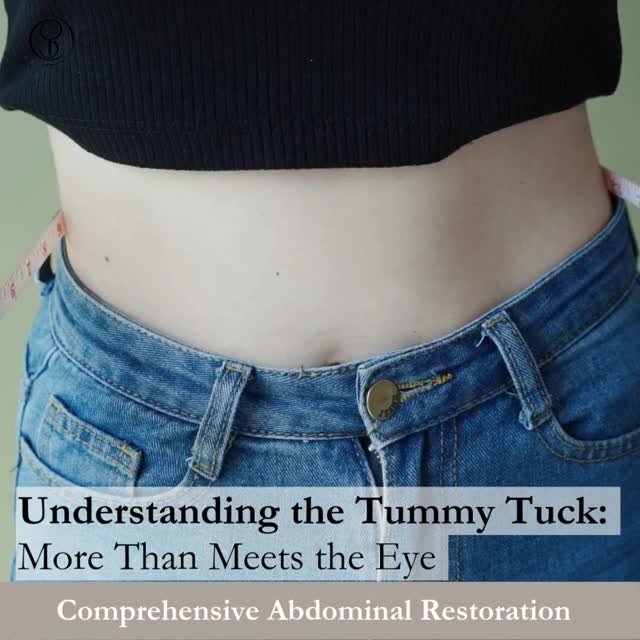 A tummy tuck (abdominoplasty) at Chao Plastic Surgery is about much more than removing excess skin - it's a comprehensive procedure that can address multiple concerns simultaneously. Dr. Chao's expertise ensures every aspect of your abdominal transfo