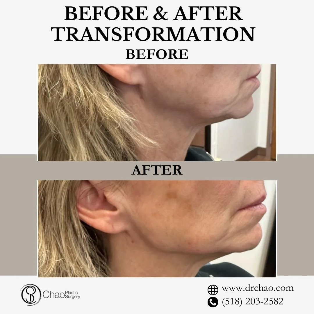 ✨ BEFORE &amp; AFTER TRANSFORMATION ✨

Stunning jawline definition with expert precision! This treatment created beautiful contour and structure, enhancing the patient's natural facial features for a more sculpted, youthful appearance.

😷 Treatment: