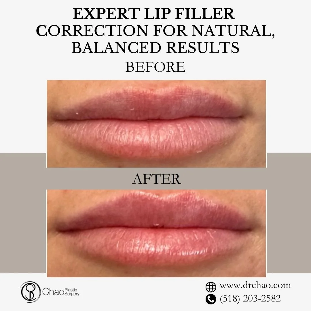 ✨ BEFORE &amp; AFTER TRANSFORMATION ✨

Gorgeous lip enhancement with natural-looking results! This patient achieved beautiful volume and definition while maintaining their authentic lip shape and perfect facial harmony.

😷 Treatment: Lip Filler 
🎯 