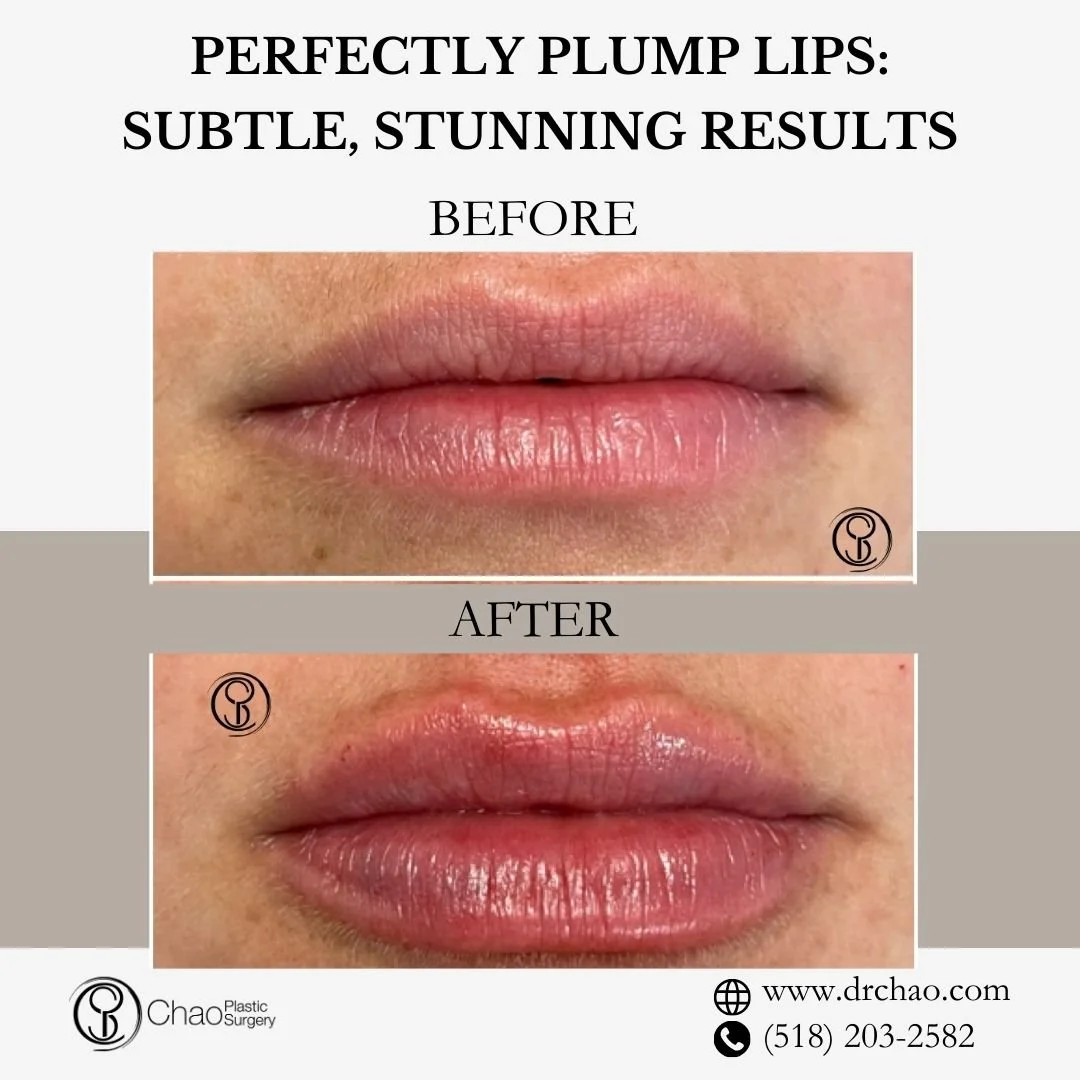 ✨ BEFORE &amp; AFTER TRANSFORMATION ✨

Perfectly enhanced lips that look completely natural! This treatment created ideal volume while respecting the patient's unique features for beautiful, balanced results.

😷 Treatment: Lip Filler 
🎯 Purpose: Li