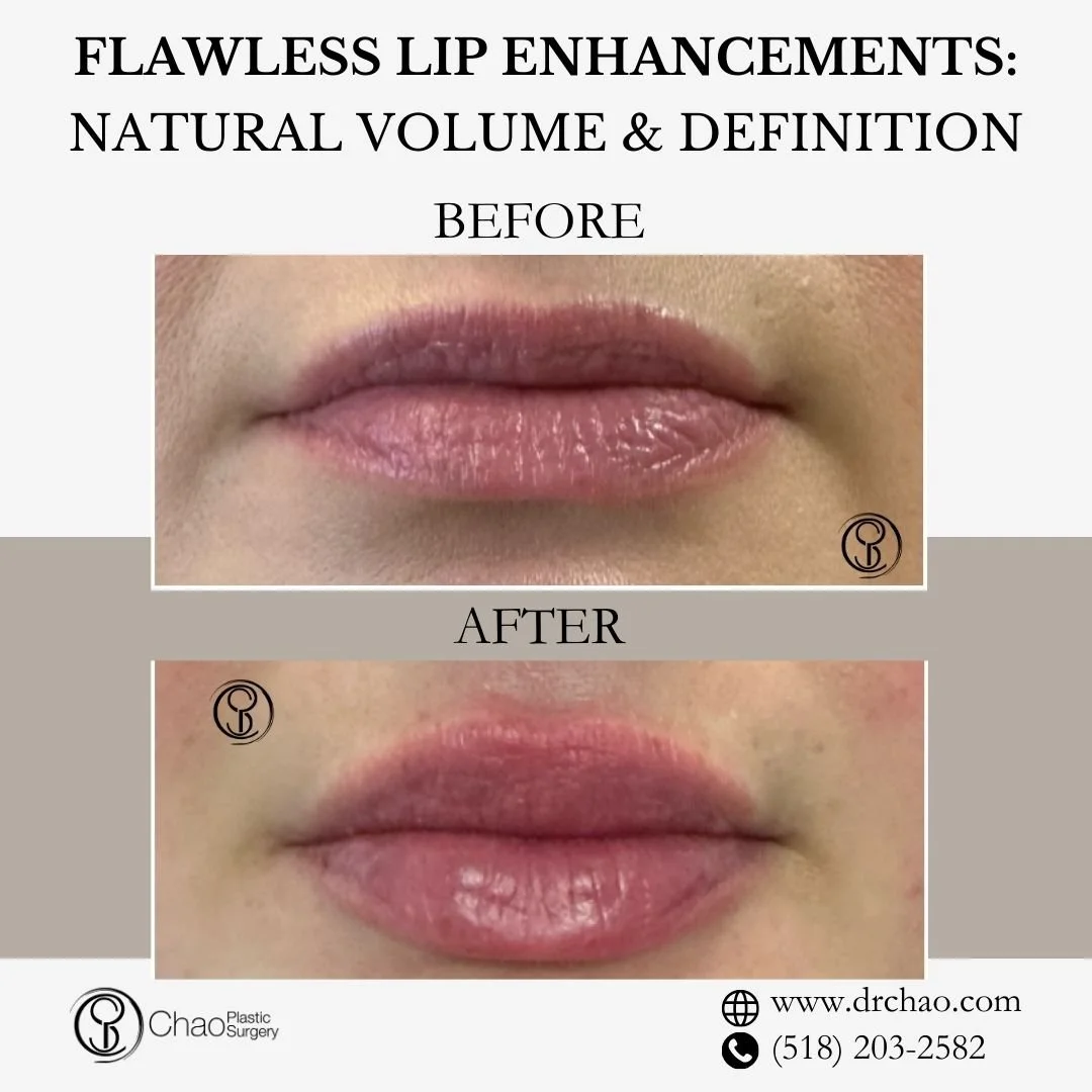 ✨ BEFORE &amp; AFTER TRANSFORMATION ✨

Flawless lip transformation with artistic technique! This patient's lips were expertly enhanced to create stunning volume and definition that complements their natural beauty perfectly.

😷 Treatment: Lip Filler