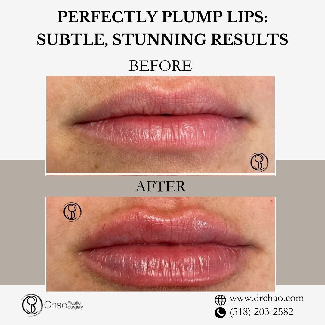 ✨ BEFORE &amp; AFTER TRANSFORMATION ✨

Perfectly enhanced lips that look completely natural! This treatment created ideal volume while respecting the patient's unique features for beautiful, balanced results.

😷 Treatment: Lip Filler 
🎯 Purpose: Li