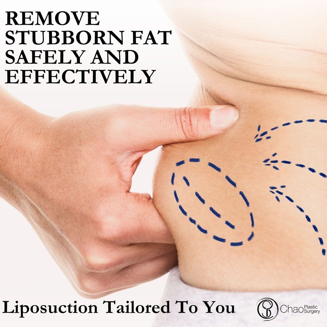 Sometimes, exercise and diet aren&rsquo;t enough to target stubborn fat. Our liposuction procedures are designed to contour areas like the abdomen, back, thighs, arms, and chin. 🖤💫

At Chao Plastic Surgery, every procedure is personalized. We focus