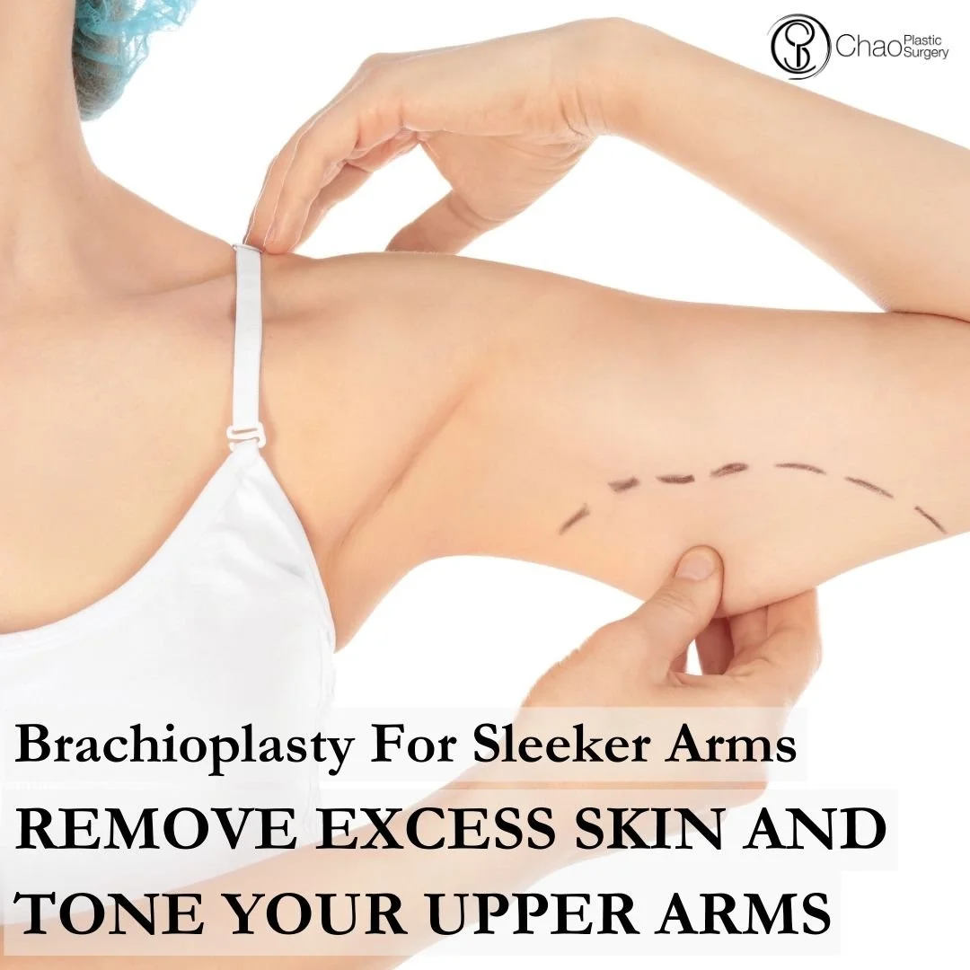 An arm lift, or brachioplasty, reshapes the upper arms by removing excess skin and tissue. Perfect after weight loss or aging changes, this procedure gives smoother, more toned arms.

🌟 Patients appreciate the natural results that improve their conf