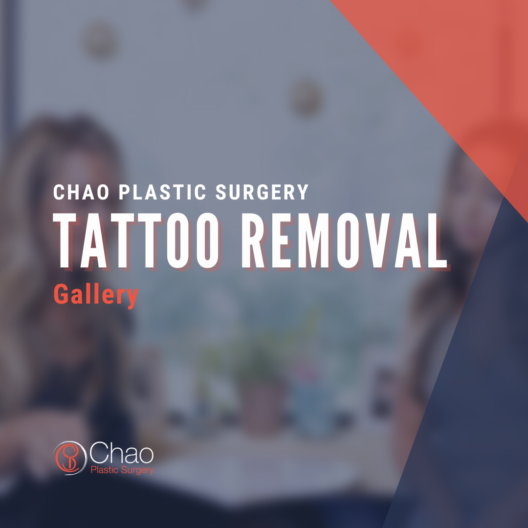 Tattoo Removal.png