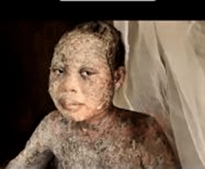 Kenya: Family Sprayed with Acid for Leaving Islam