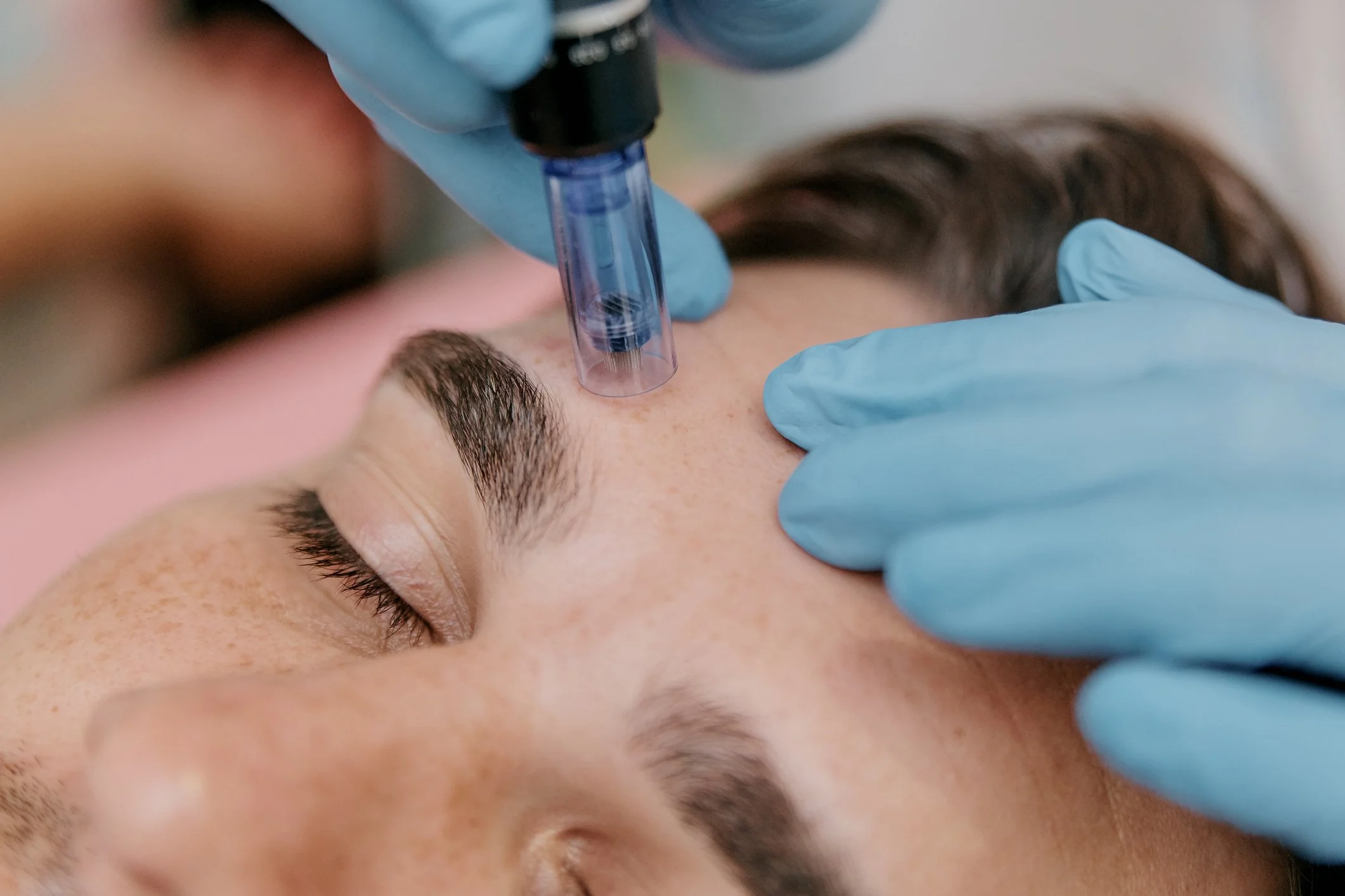 A person lying down while a medical professional, wearing blue gloves, is preparing to perform a skincare procedure, possibly a cosmetic injection, on their face.