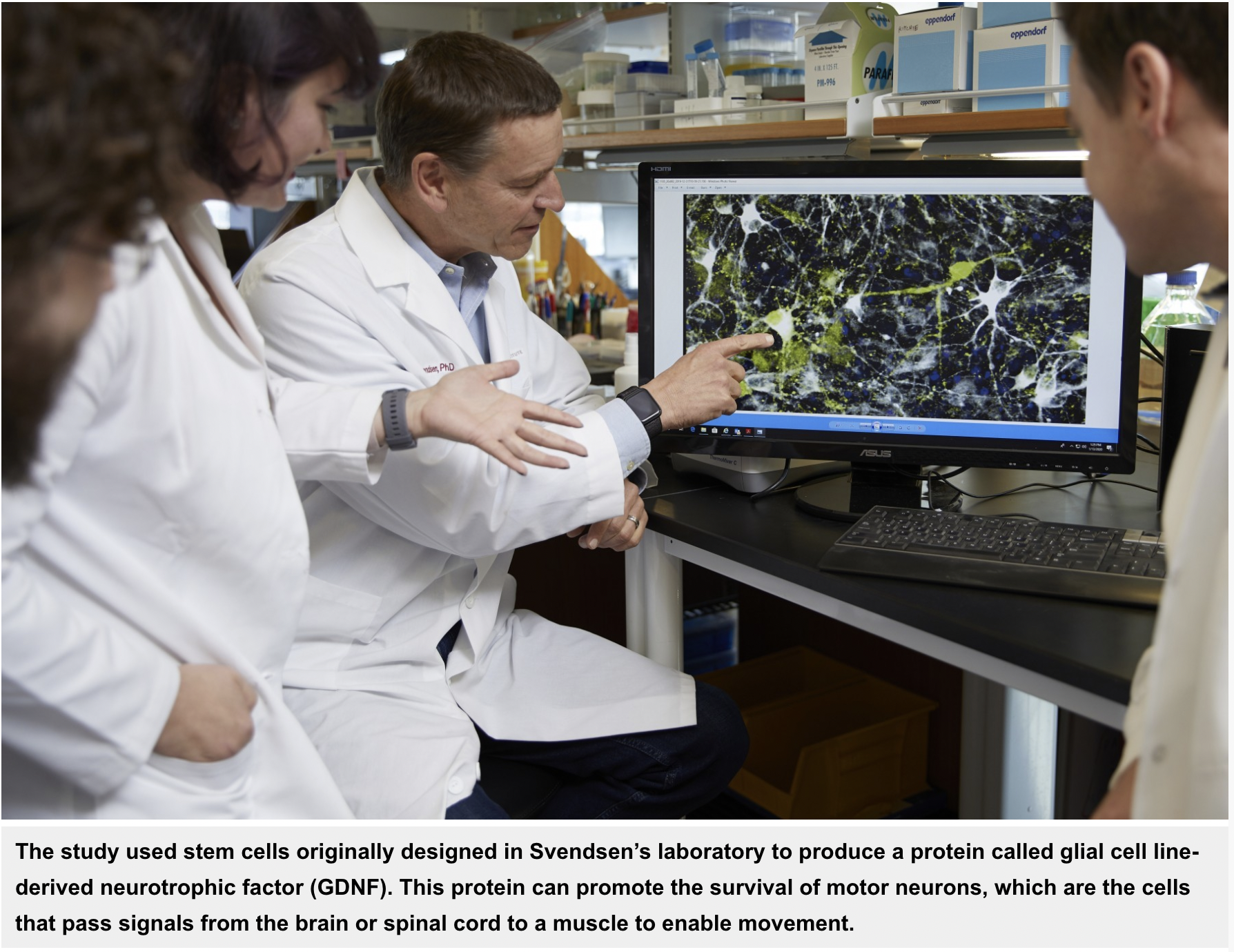 Stem Cell-Gene Therapy Shows Promise in ALS Safety Trial