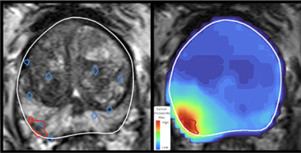 AI-Enhanced Prostate Cancer Treatment: Interview with Brittany Berry-Pusey, Co-Founder and COO at Avenda Health