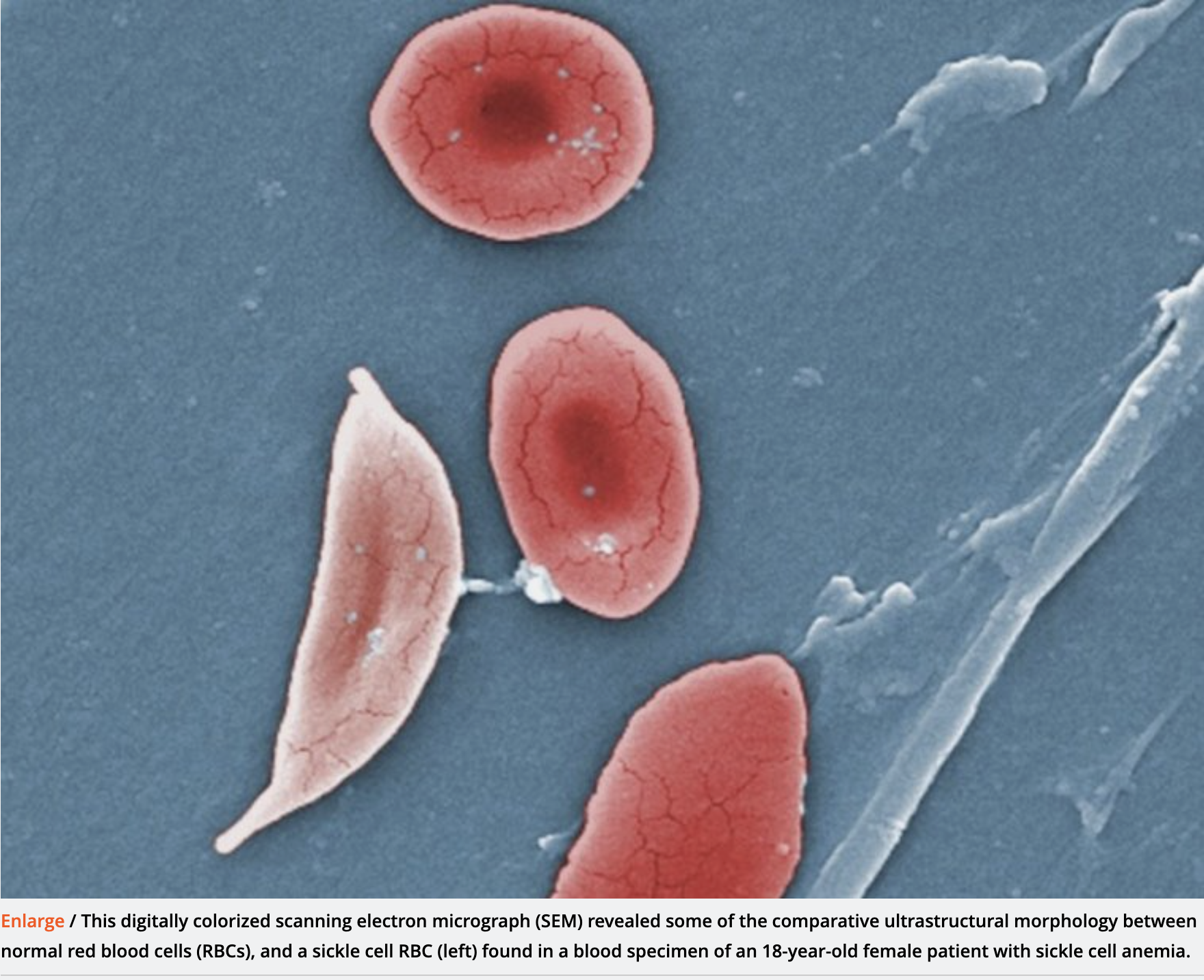 FDA approves first CRISPR therapy—here’s how it works against sickle cell