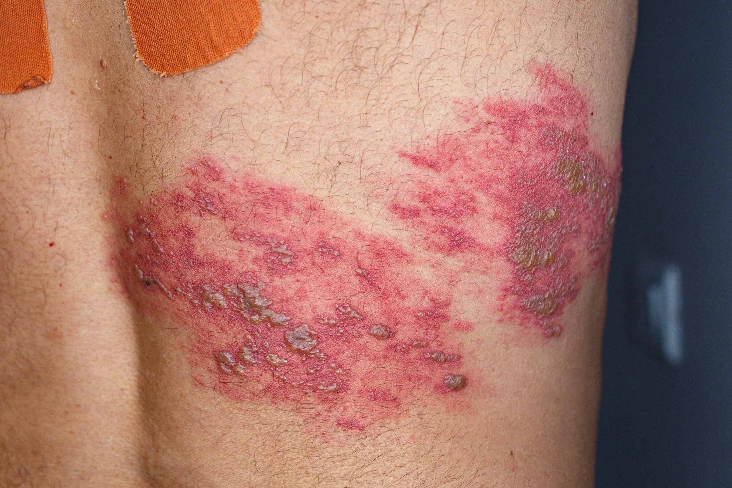 Postherpetic Neuralgia Natural Treatments Homeopathy & Integrative