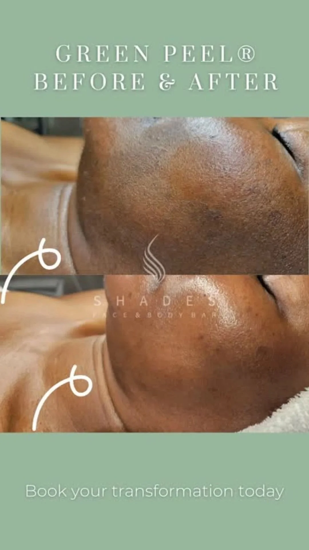 Comparison of a woman's face before and after skin treatment. The top image shows skin with hyperpigmentation, dark spots, and uneven texture. The bottom image shows a smoother, clearer complexion with reduced dark spots and even skin tone.