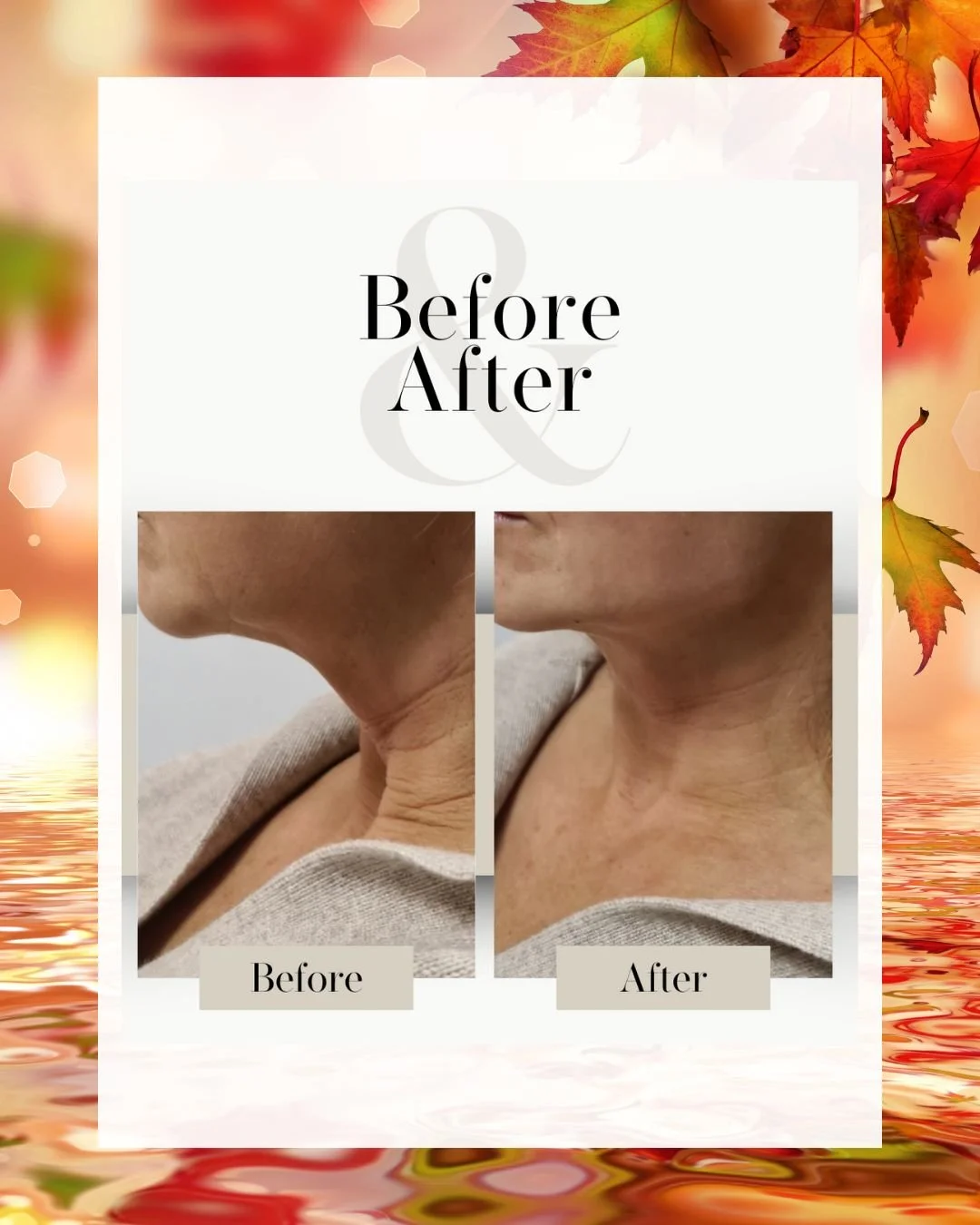 Side-by-side comparison of a woman's neck and lower face, showing a reduction in wrinkles and sagging from before to after a treatment, with a background of autumn leaves and water.