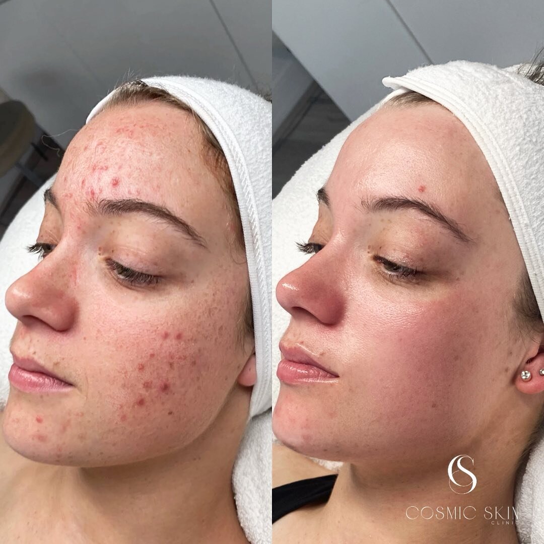 Understanding Inflammed Acne ✨

Inflamed acne, also known as inflammatory acne, is a common skin condition characterized by the presence of red, swollen, and painful pimples or nodules. It typically occurs when hair follicles Treatments like topical 