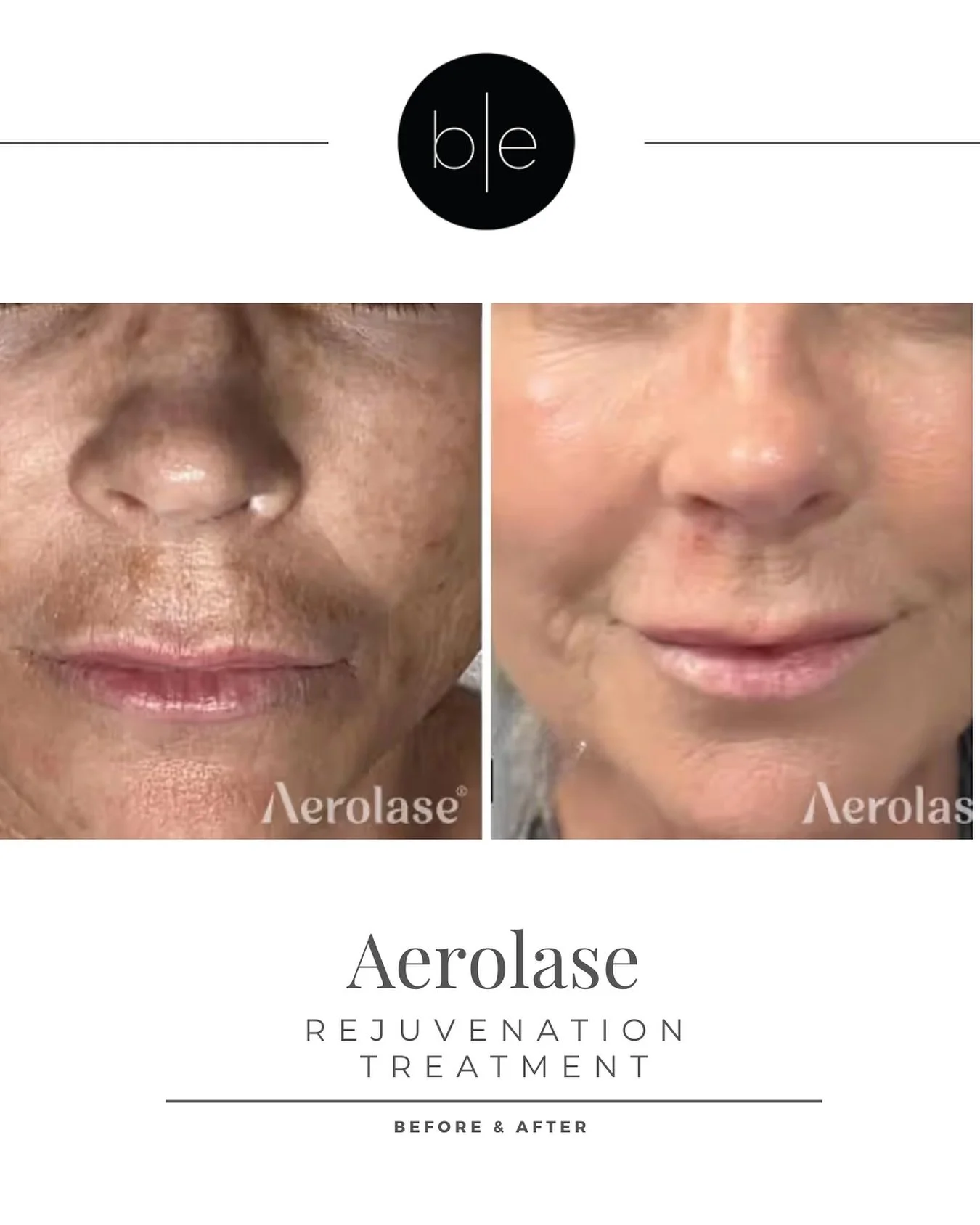 Aerolase treats fine lines and wrinkles by using a gentle laser to stimulate the skin&rsquo;s natural production of collagen and elastin, proteins that provide skin firmness and elasticity. This process renews the skin&rsquo;s surface, strengthens it