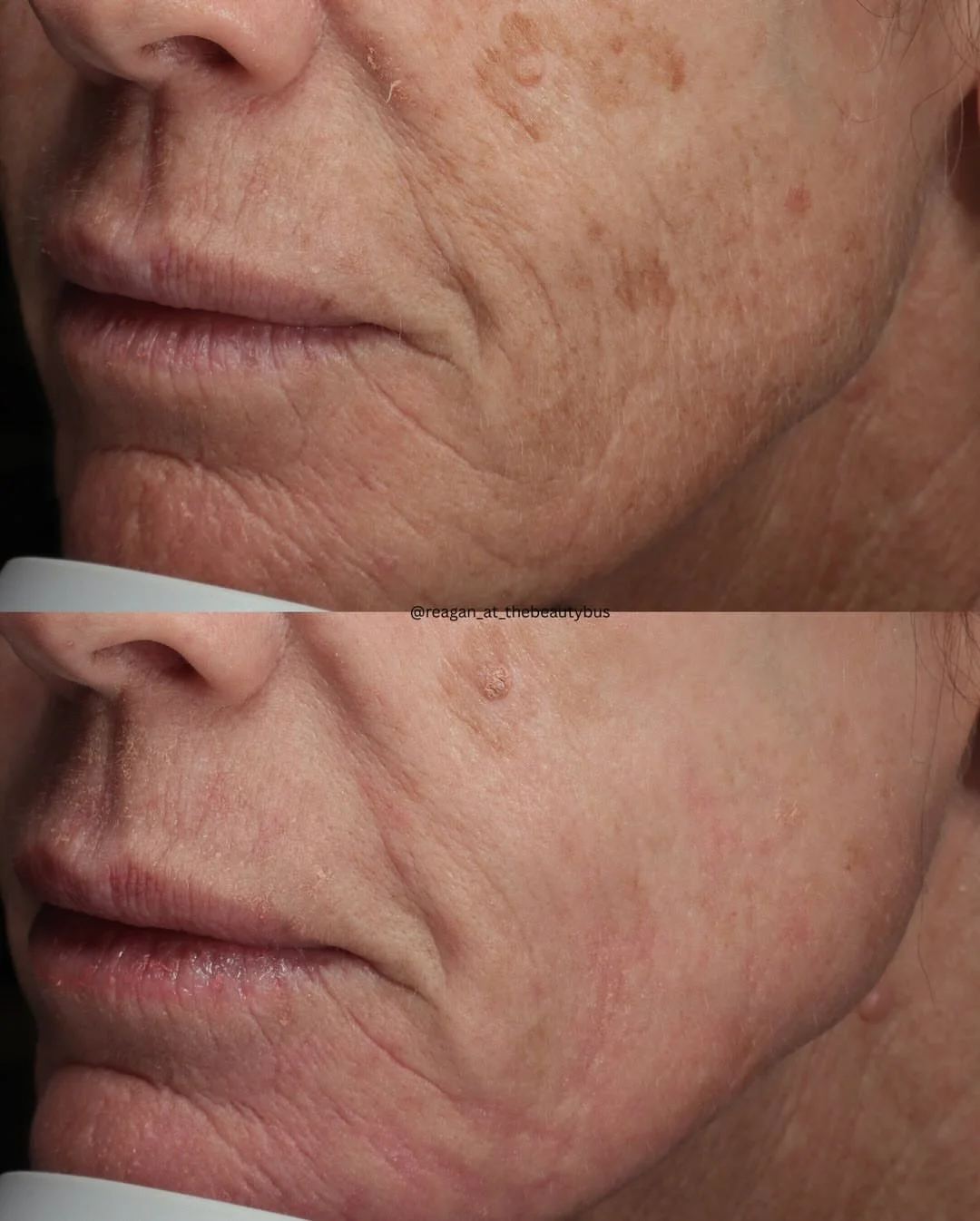 Fine lines softened. Texture smoothed. Pigment visibly improved.

Aerolase Era = THE total skin rejuvenation experience